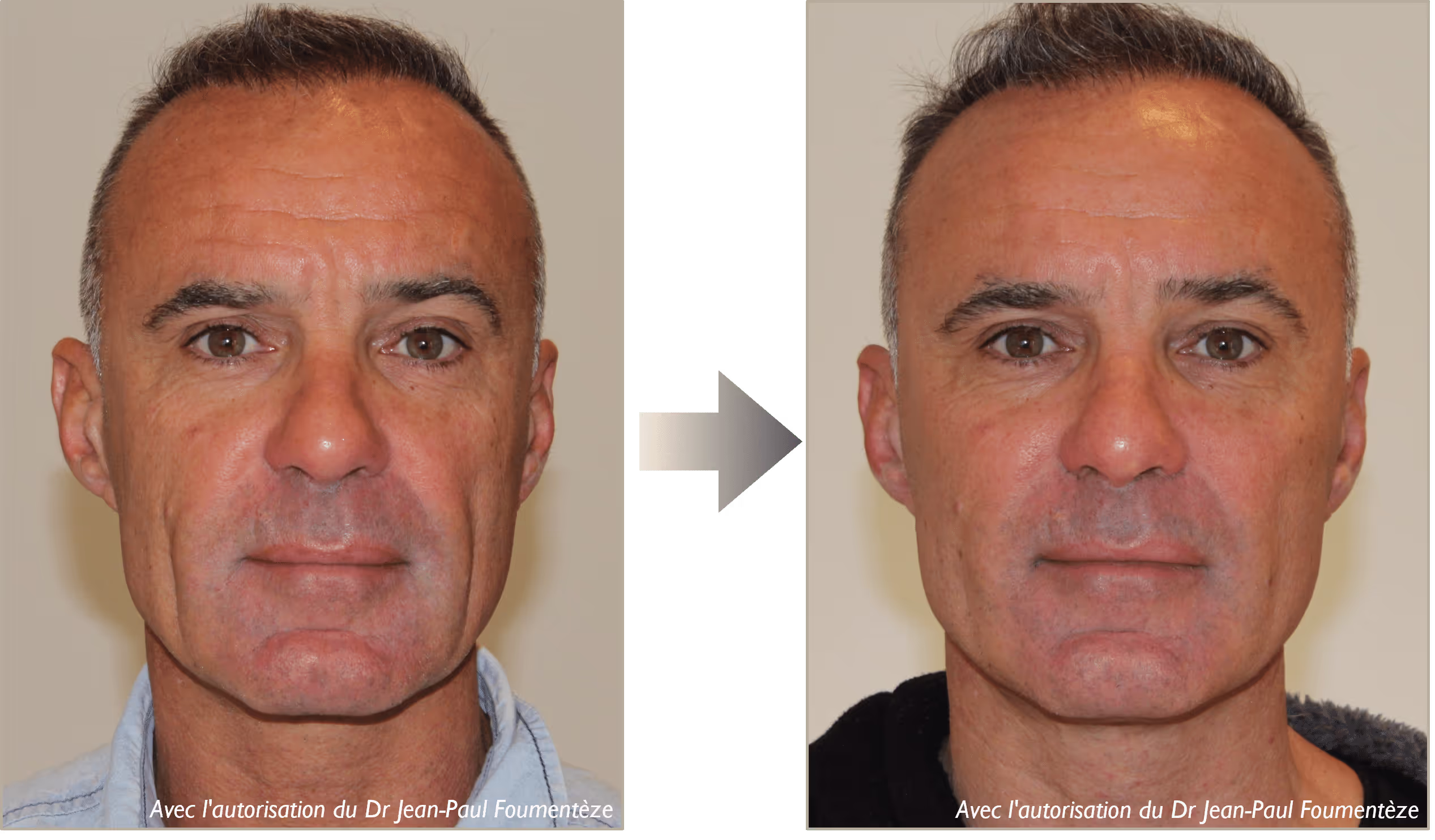 2 images d'un même homme, cheveux courts et grisonnants, yeux marrons et verts, avant et après l'opération des fils tenseurs