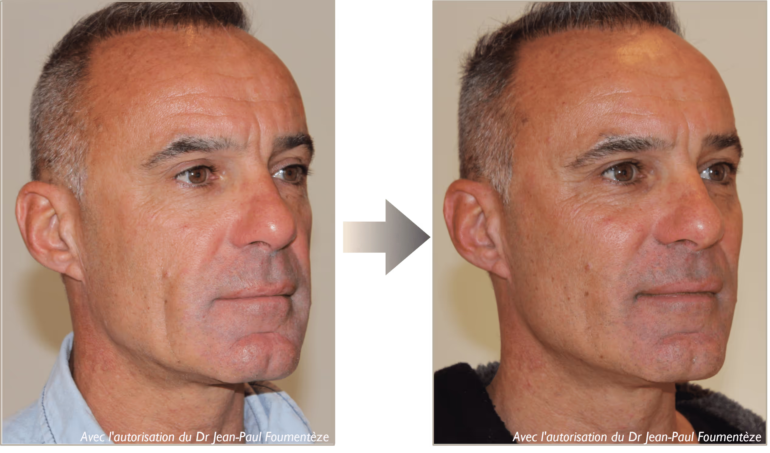 2 images d'un même homme, cheveux courts et grisonnants, yeux marrons et verts, avant et après l'opération des fils tenseurs