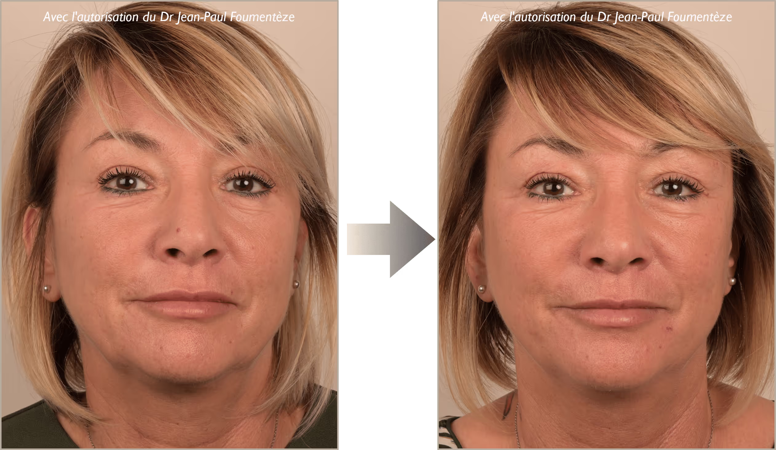 2 images d'une même femme, blonde aux yeux marrons, avant et après l'opération des fils tenseurs