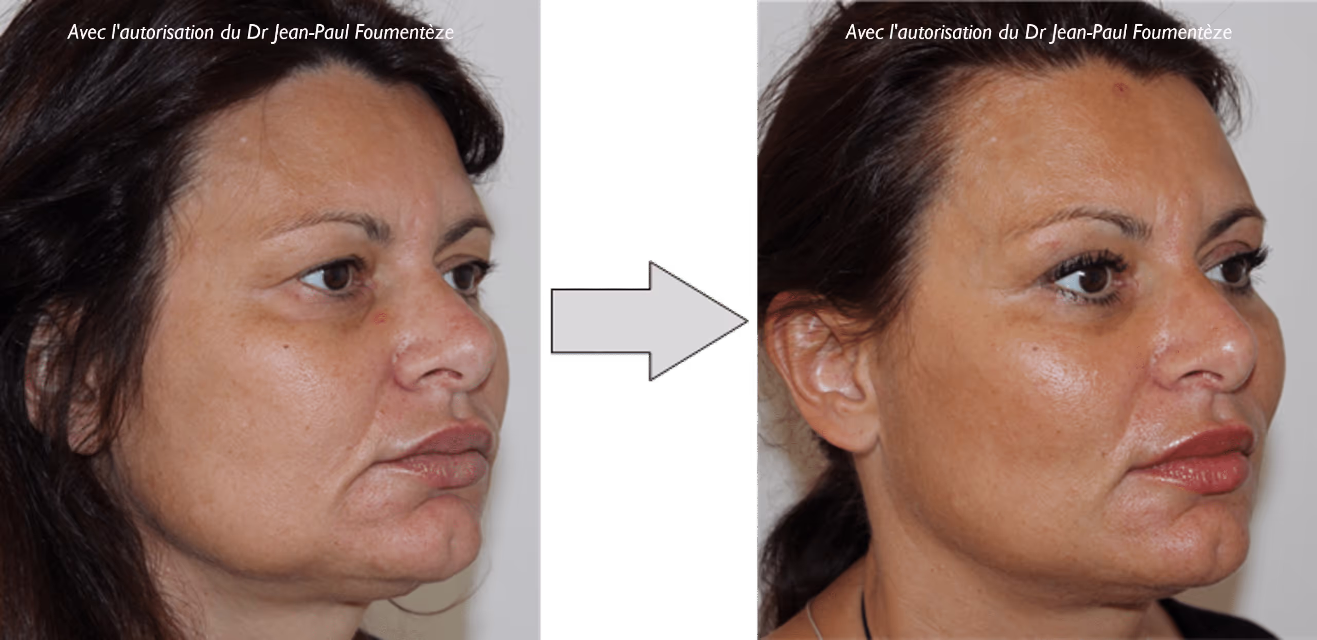 2 images d'une même femme, brune aux yeux marrons, avant et après l'opération des fils tenseurs
