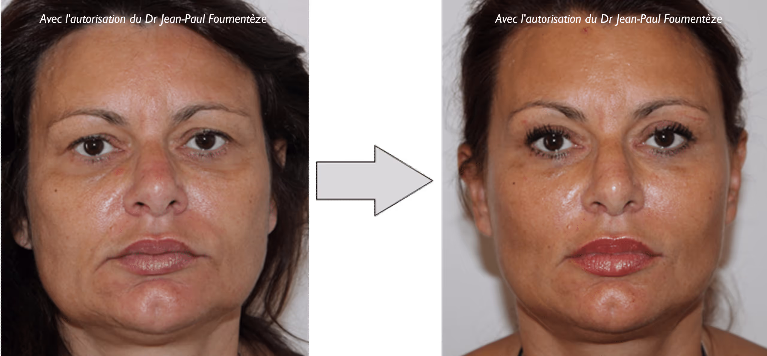 2 images d'une même femme, brune aux yeux marrons, avant et après l'opération des fils tenseurs