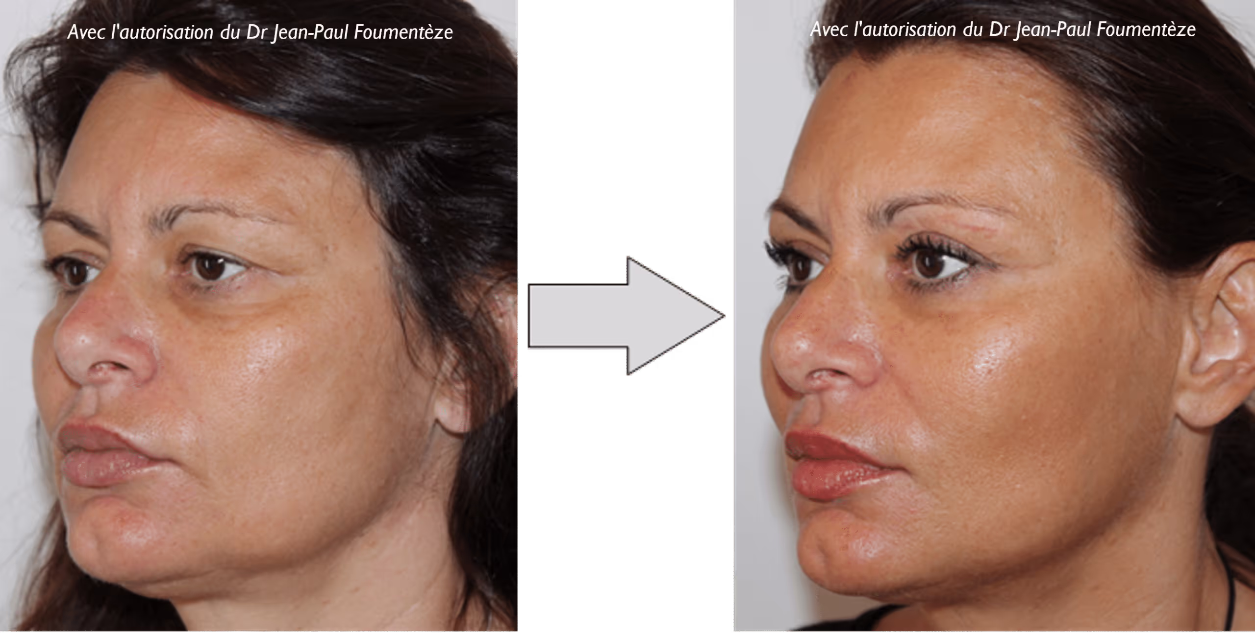 2 images d'une même femme, brune aux yeux marrons, avant et après l'opération des fils tenseurs