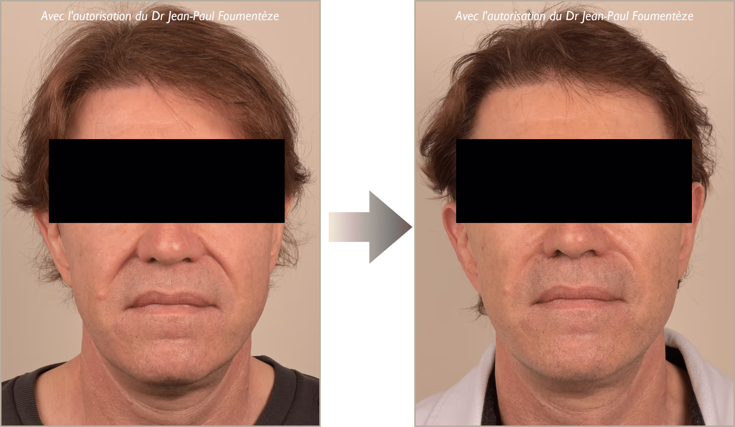 2 images d'un même homme, cheveux châtains, avant et après l'opération des fils tenseurs