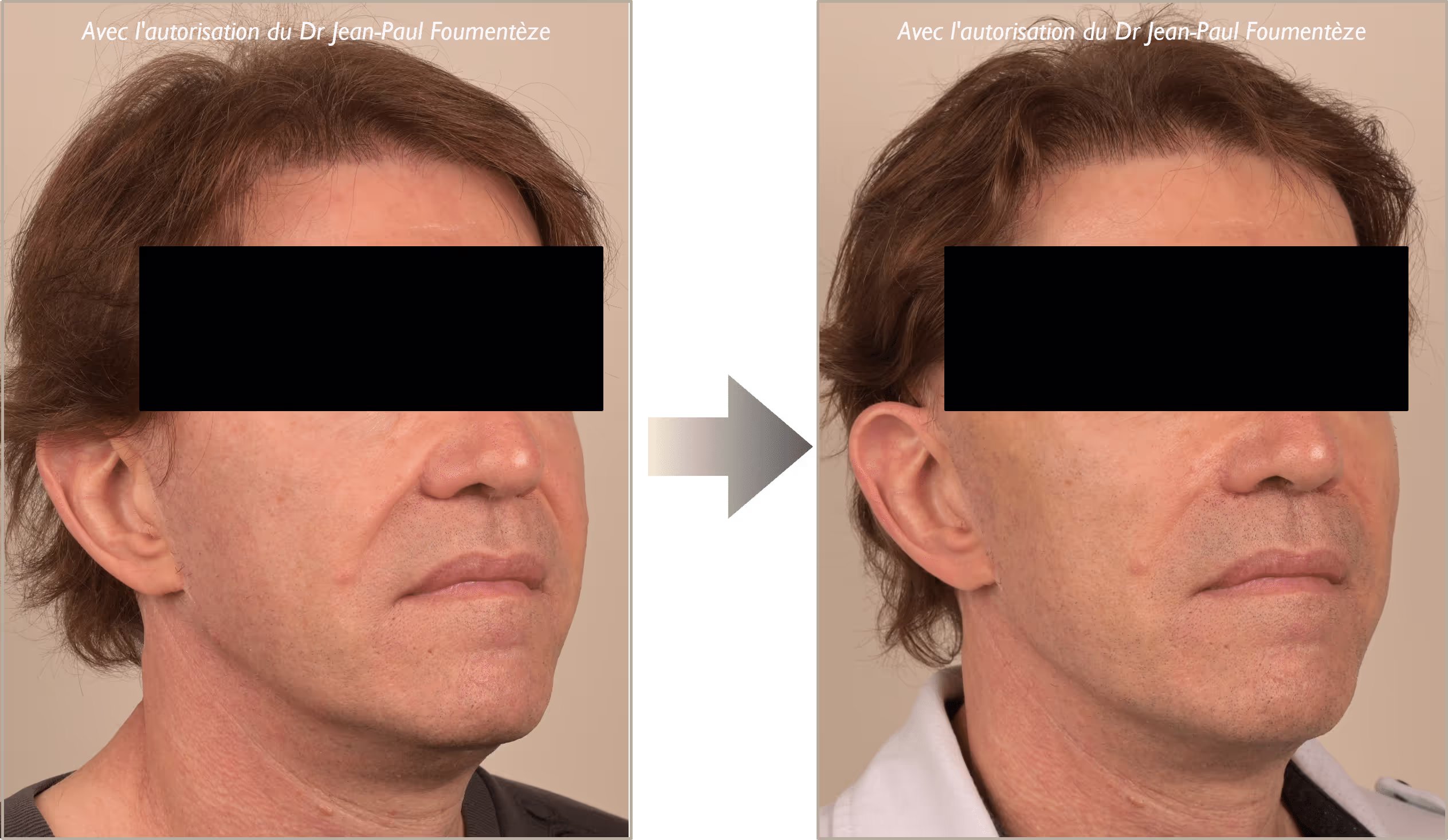 2 images d'un même homme, cheveux châtains, avant et après l'opération des fils tenseurs
