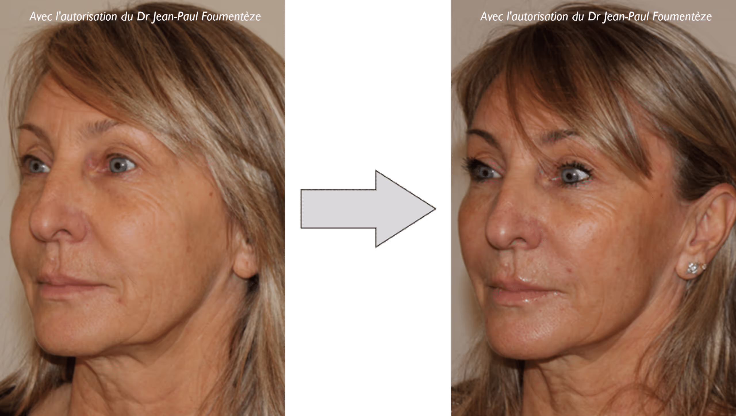 2 images d'une même femme, blonde aux yeux bleus, avant et après l'opération des fils tenseurs