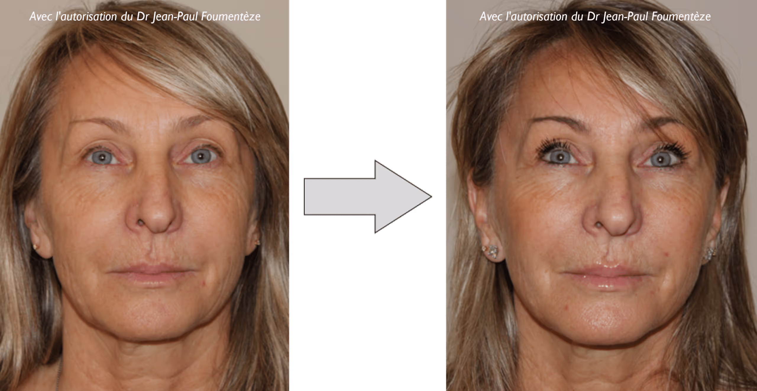2 images d'une même femme, blonde aux yeux bleus, avant et après l'opération des fils tenseurs