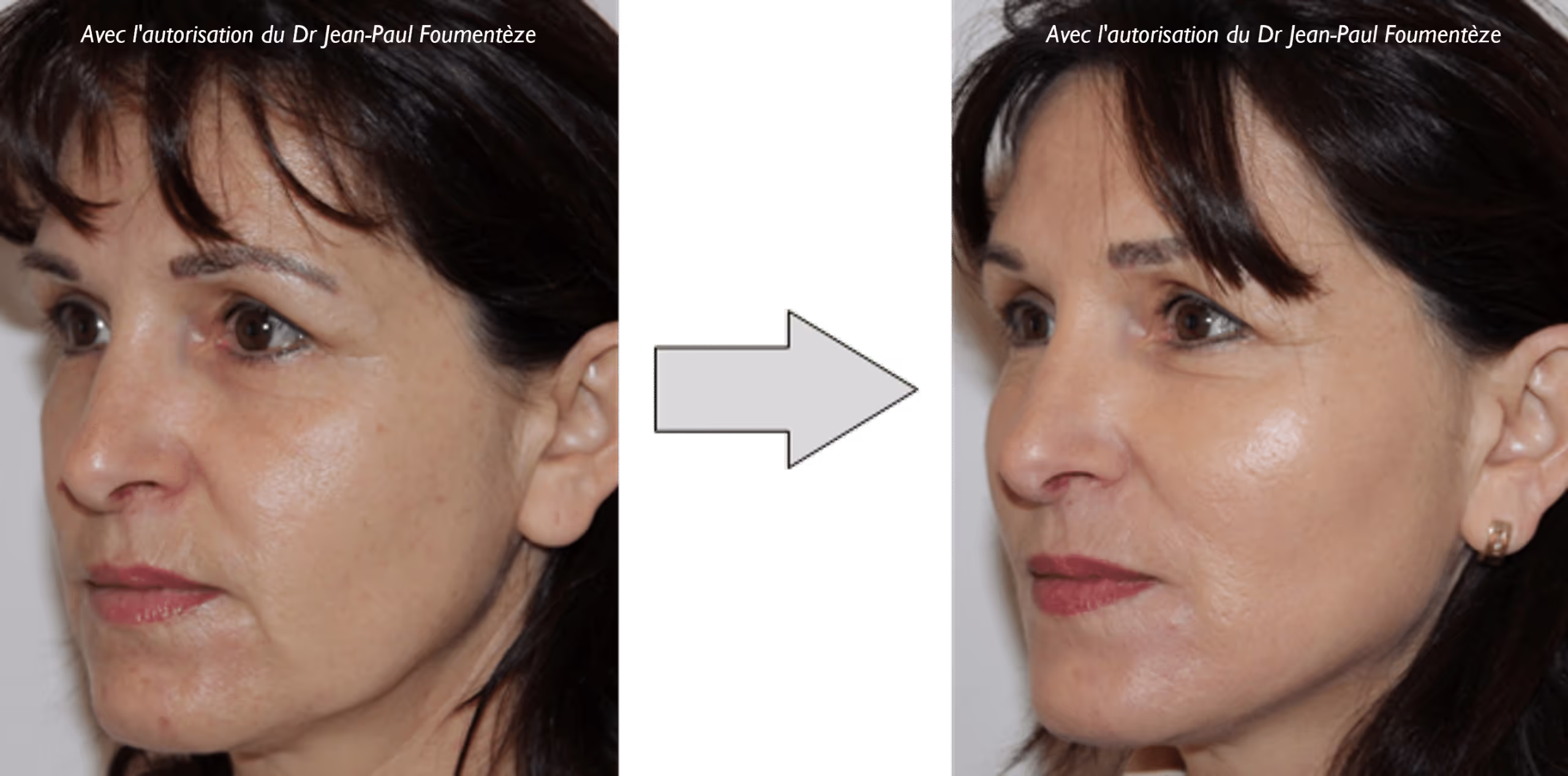 2 images d'une même femme, brune aux yeux marrons, avant et après l'opération des fils tenseurs