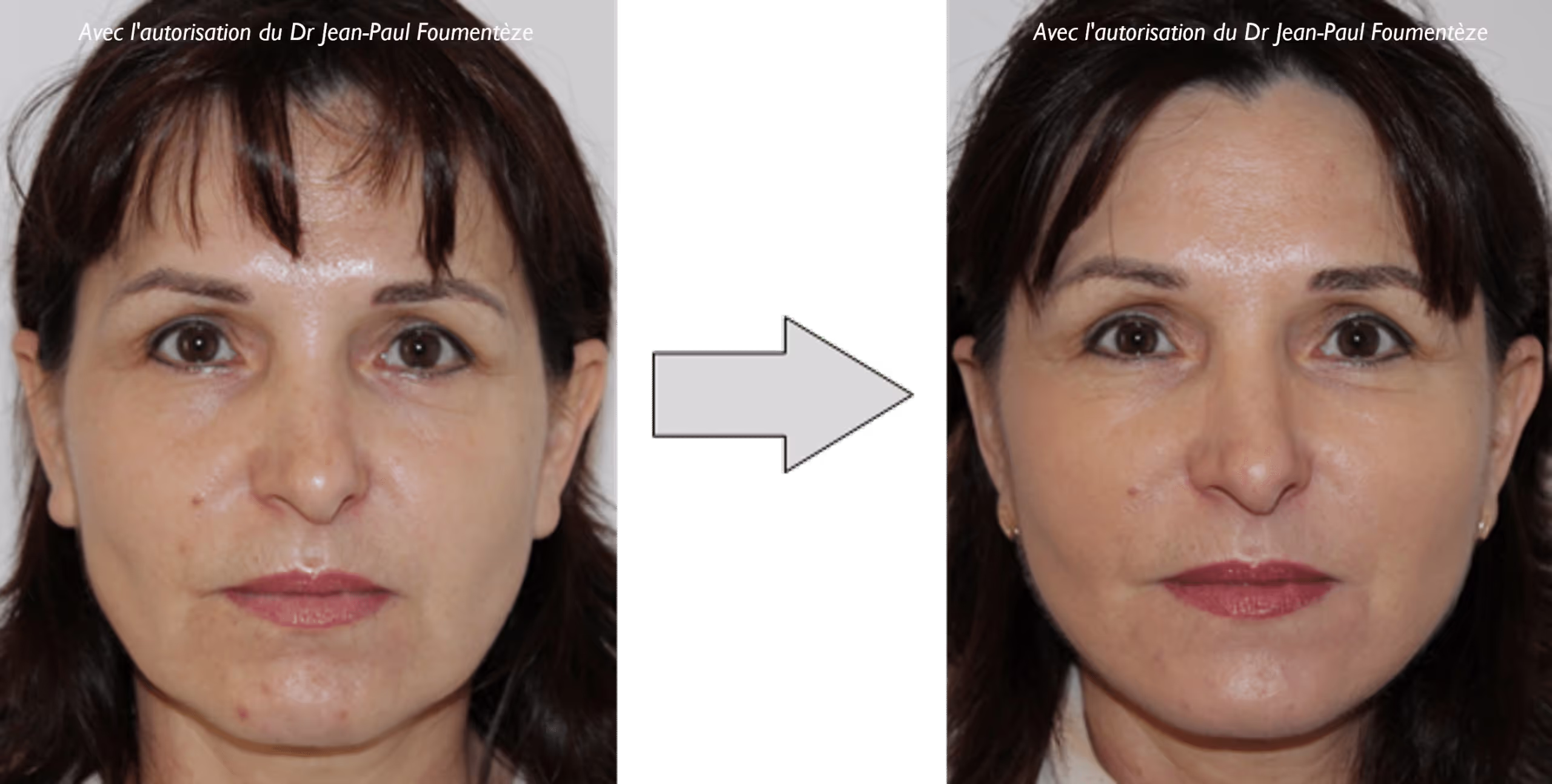 2 images d'une même femme, brune aux yeux marrons, avant et après l'opération des fils tenseurs