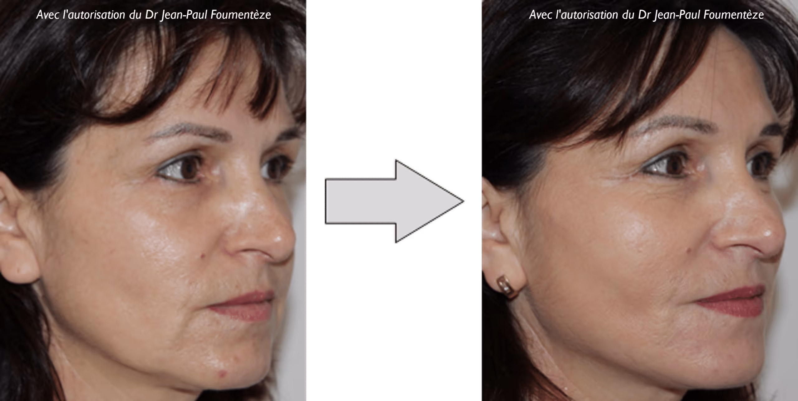 2 images d'une même femme, brune aux yeux marrons, avant et après l'opération des fils tenseurs