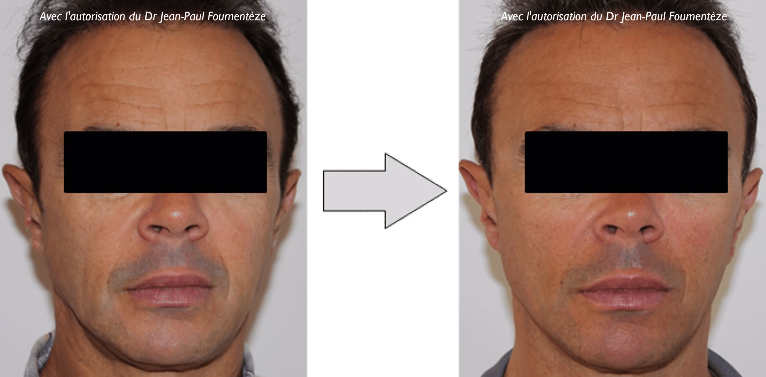 2 images d'un même homme, brun, avant et après l'opération des fils tenseurs