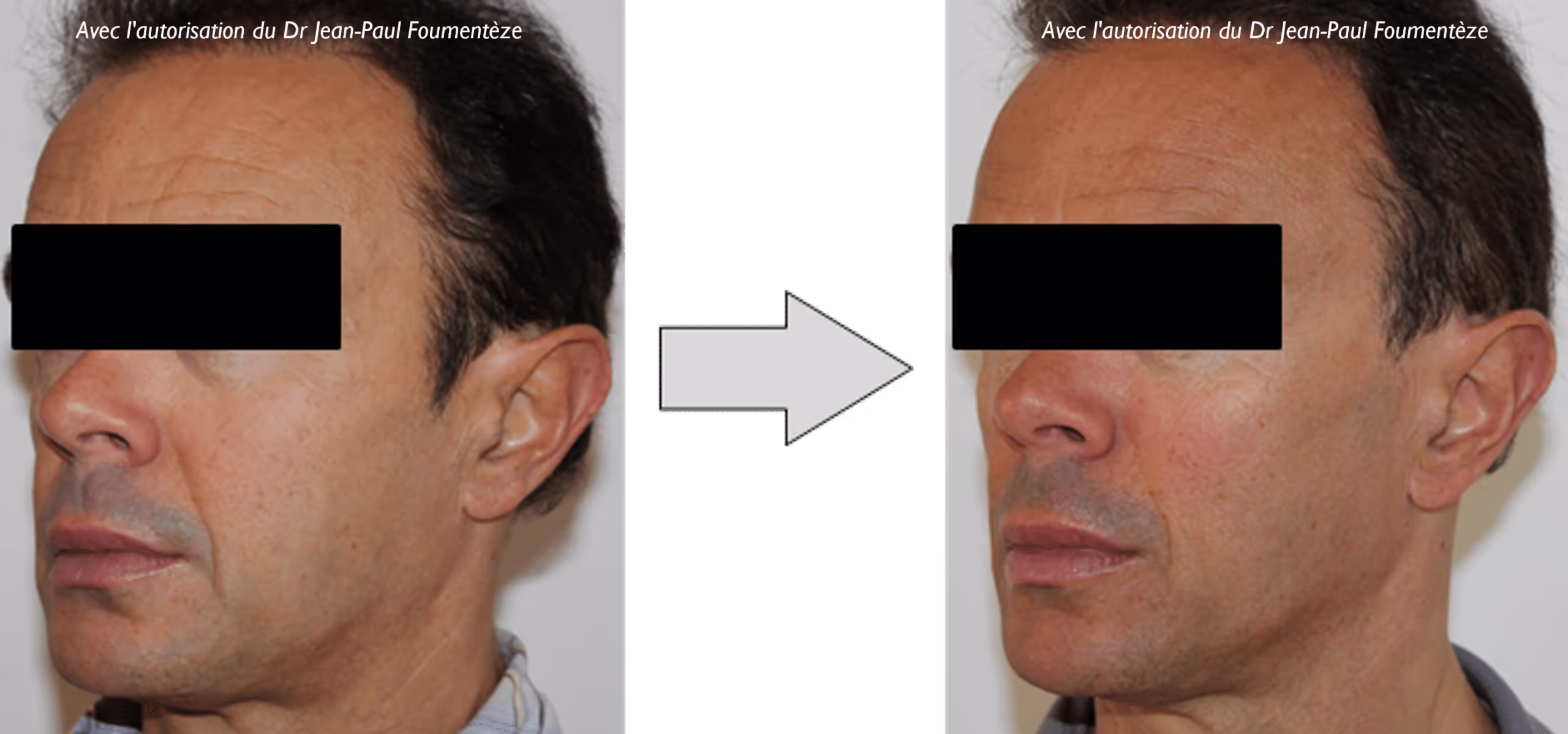 2 images d'un même homme, brun, avant et après l'opération des fils tenseurs