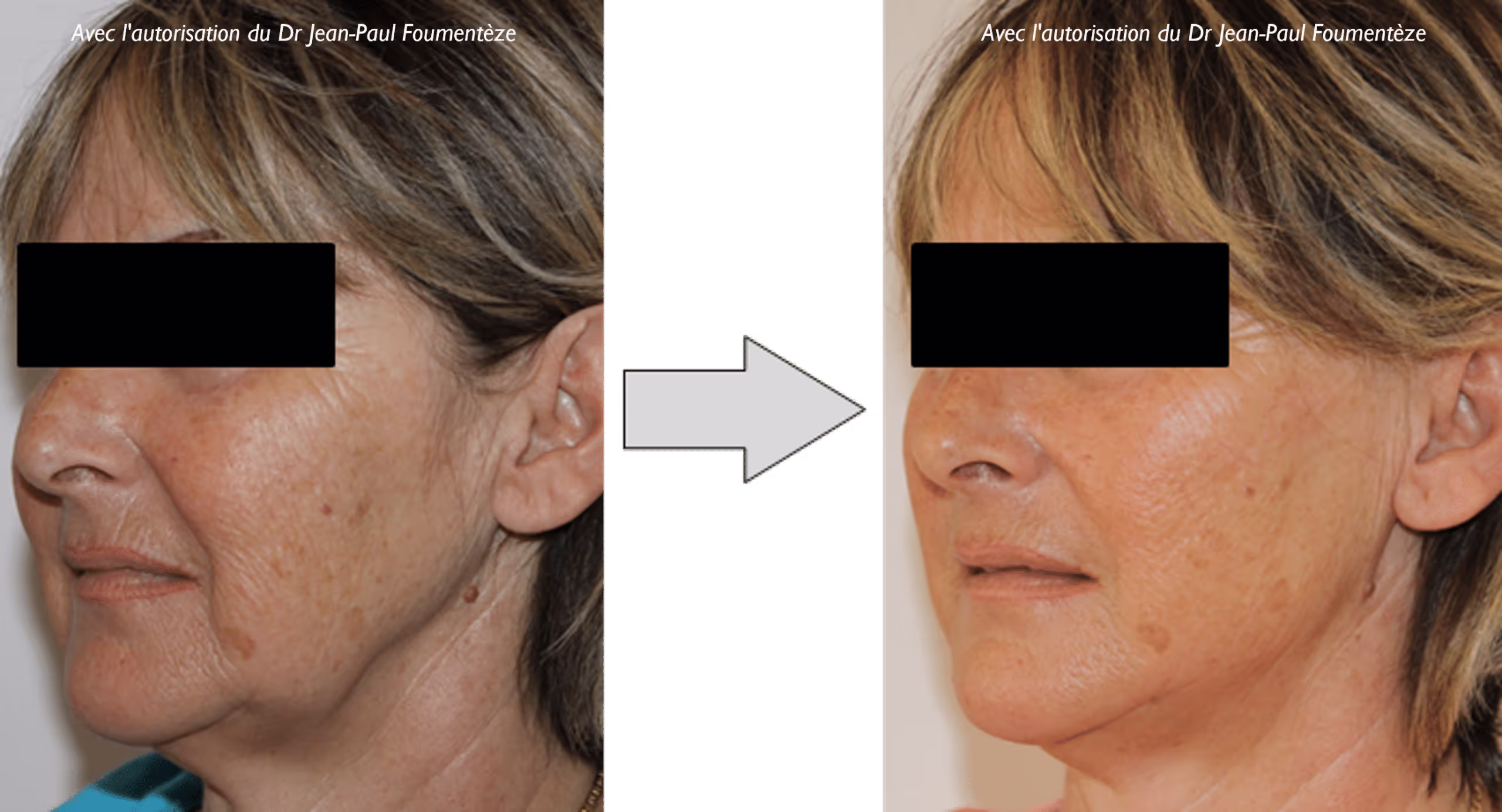 2 images d'une même femme, blonde, avant et après l'opération des fils tenseurs