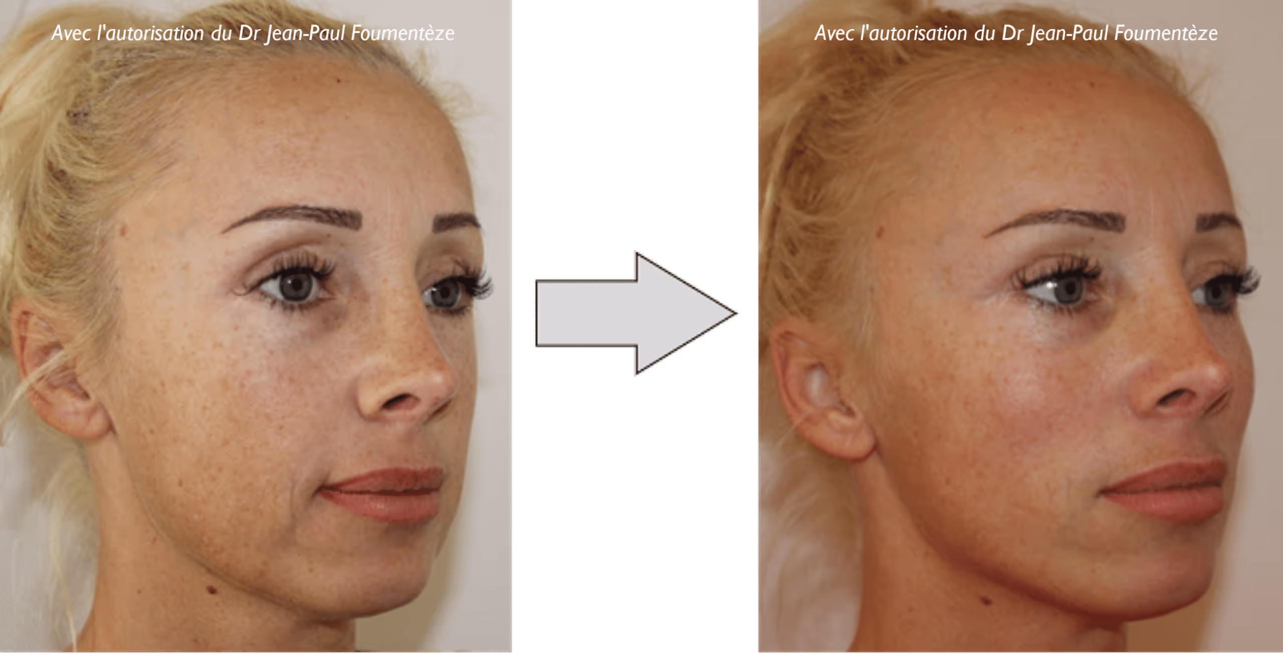 2 images d'une même femme, blonde aux yeux bleus, avant et après l'opération des fils tenseurs