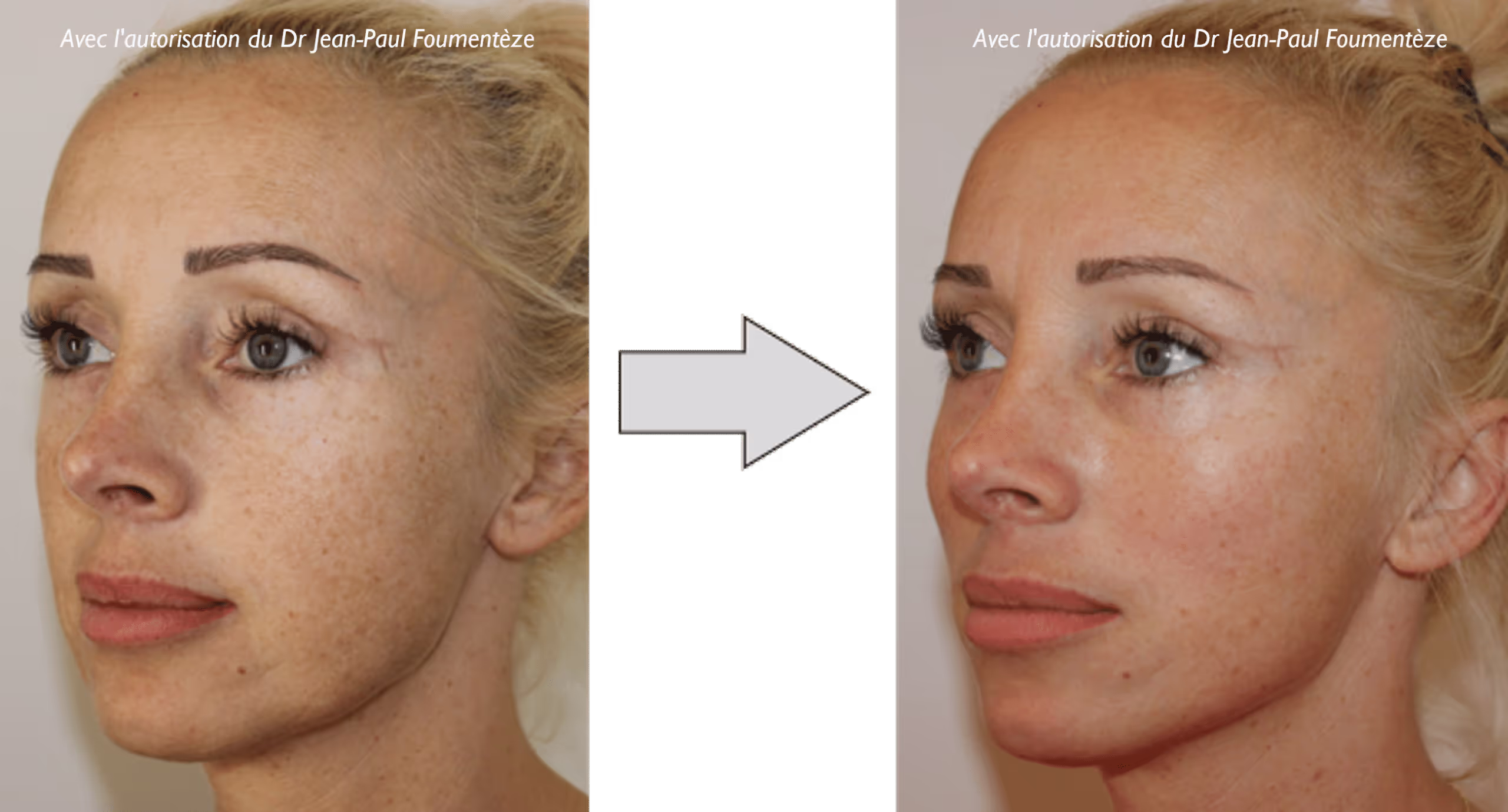 2 images d'une même femme, blonde aux yeux bleus, avant et après l'opération des fils tenseurs