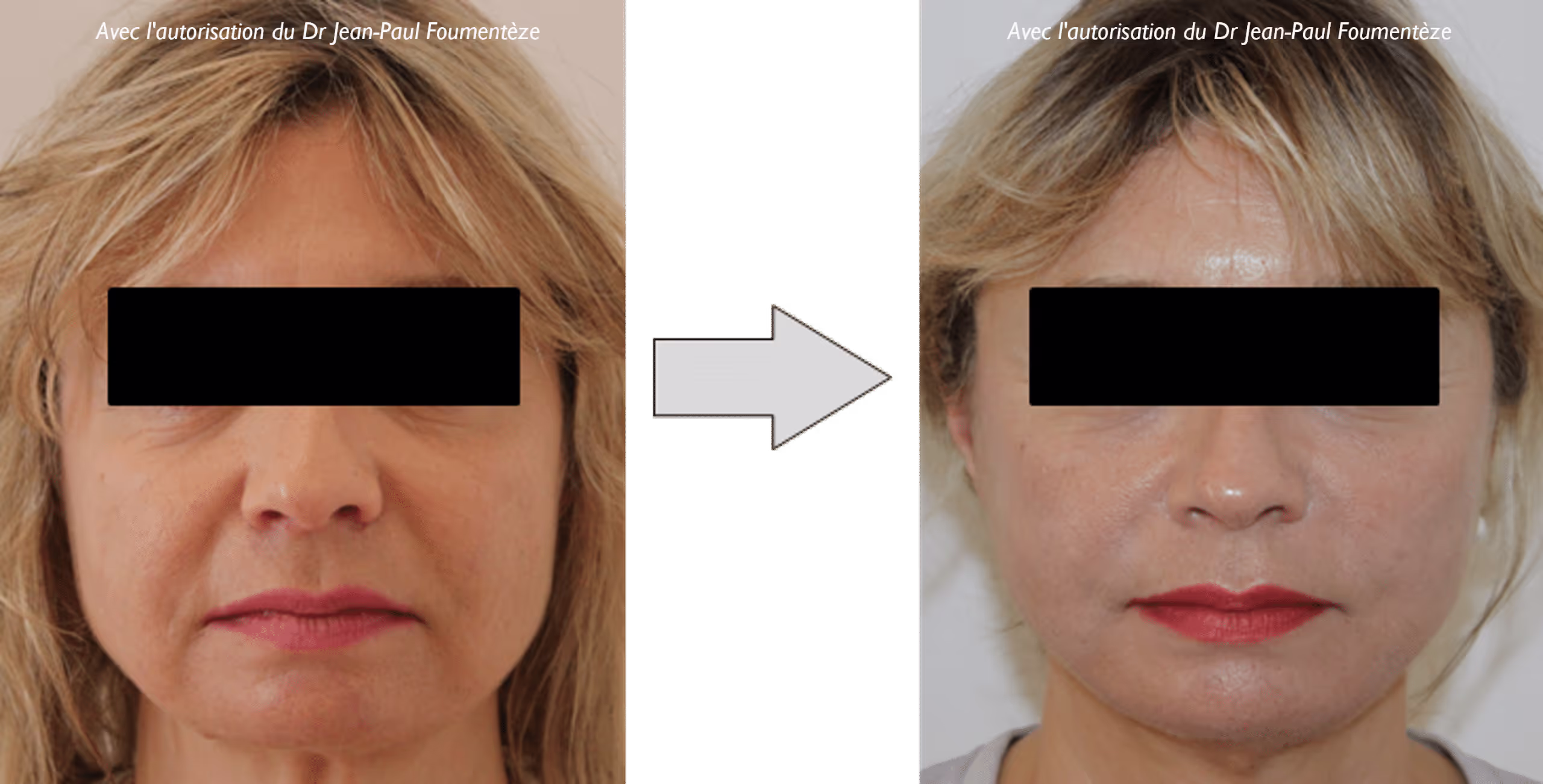 2 images d'une même femme, blonde, avant et après l'opération des fils tenseurs