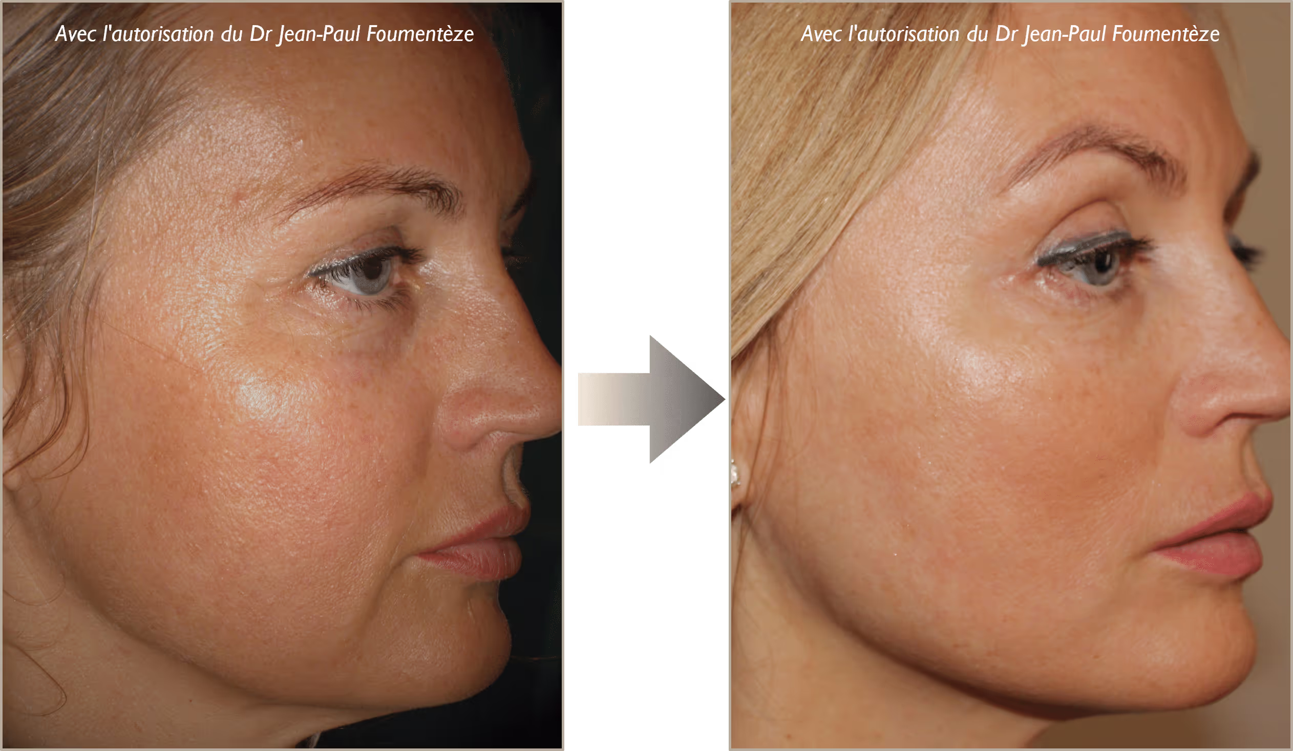 2 images d'une même femme, blonde aux yeux bleus, avant et après l'opération des fils tenseurs