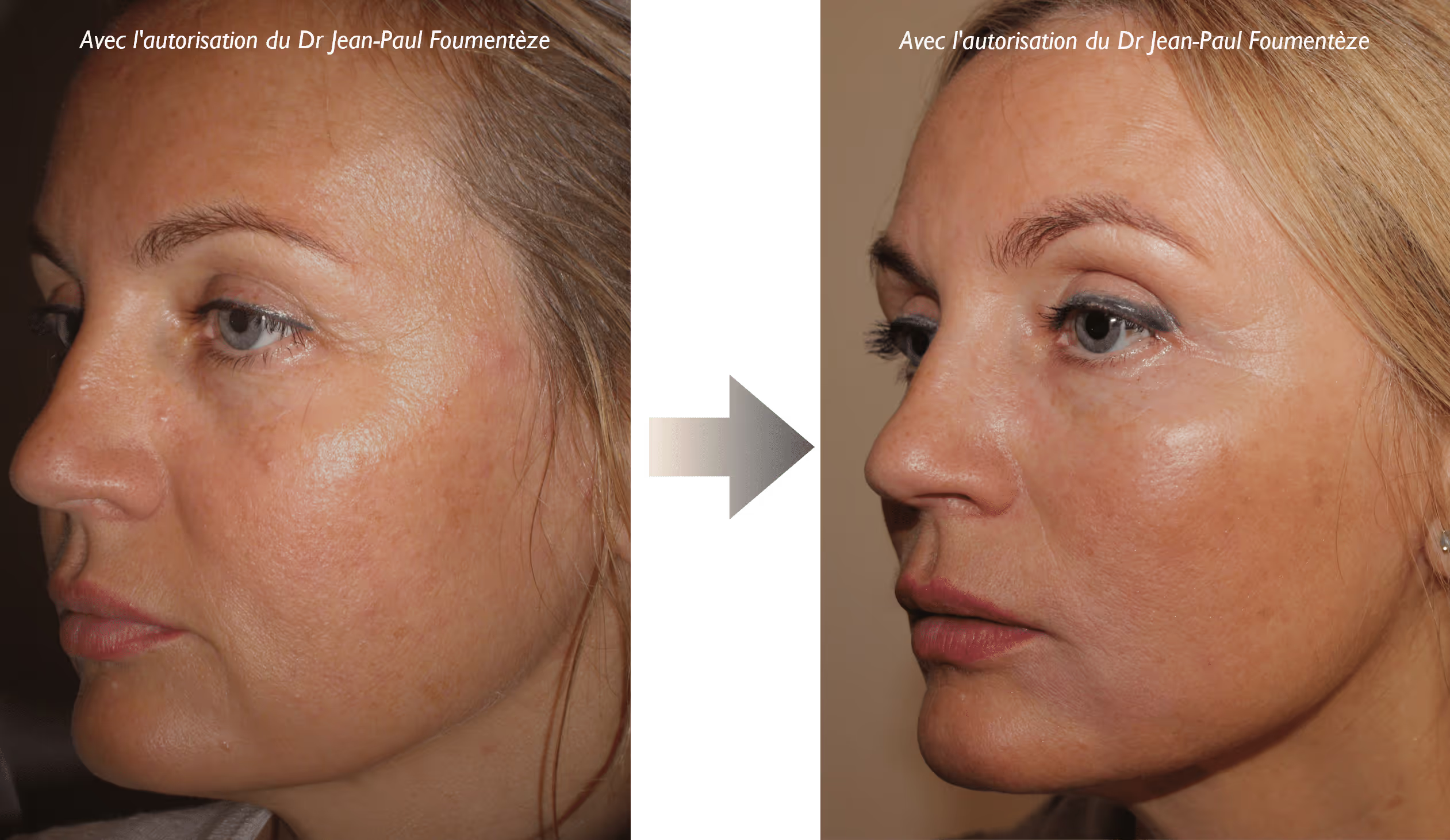 2 images d'une même femme, blonde aux yeux bleus, avant et après l'opération des fils tenseurs