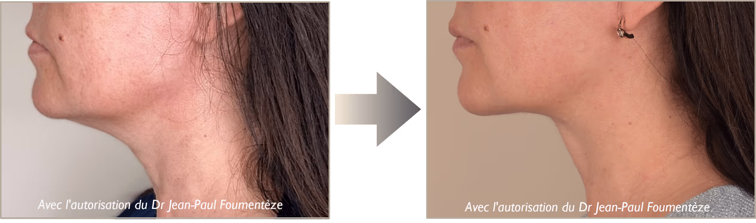 2 photos du bas du visage d'une même femme brune, avant et après l'opération fils tenseurs.