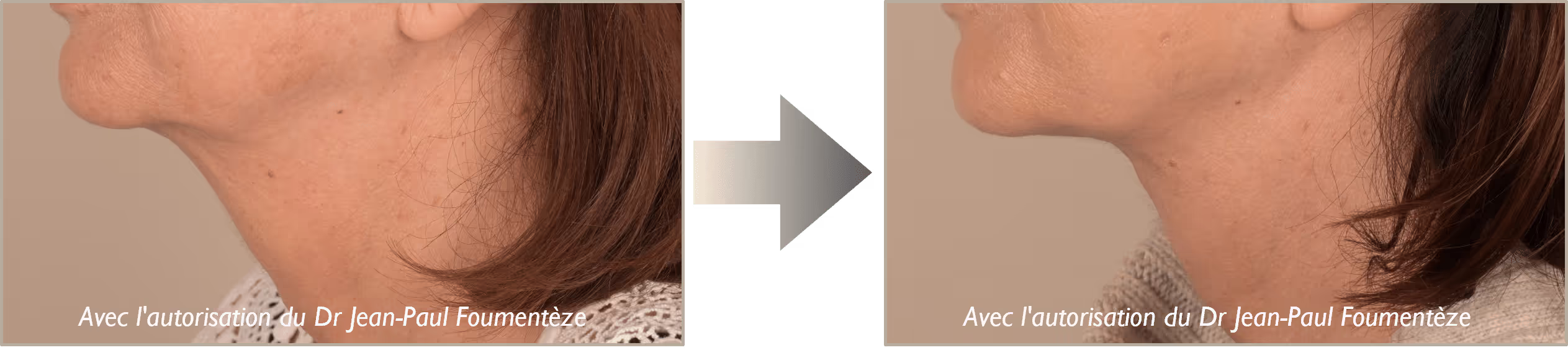 2 photos du bas du visage d'une même femme brune, avant et après l'opération fils tenseurs.