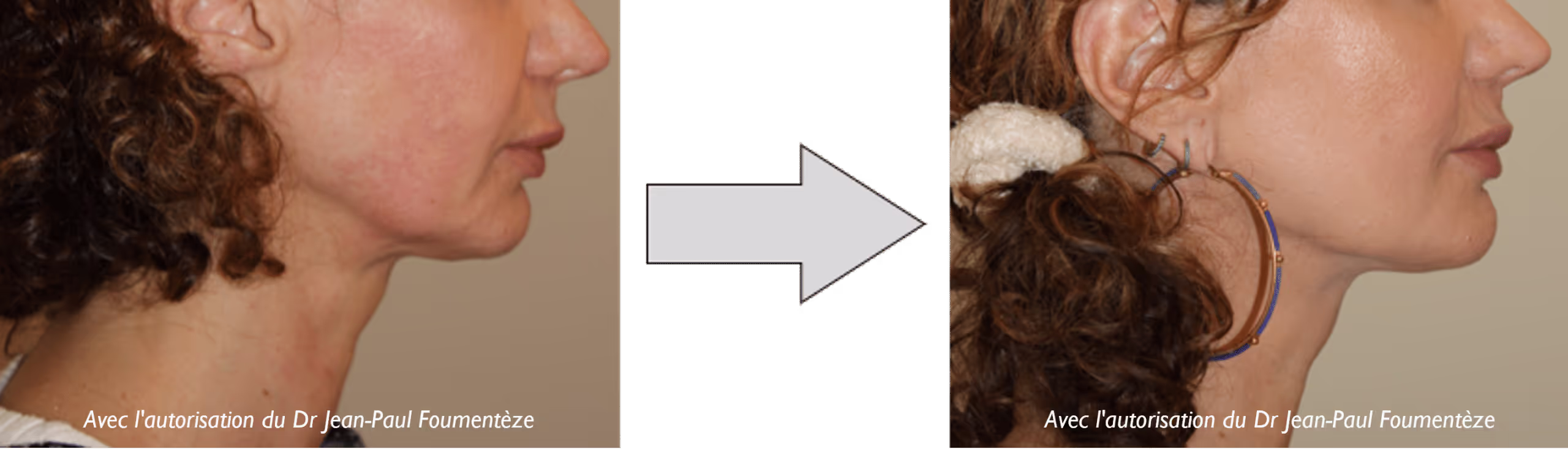 2 photos du bas du visage d'une même femme brune, avant et après l'opération fils tenseurs.
