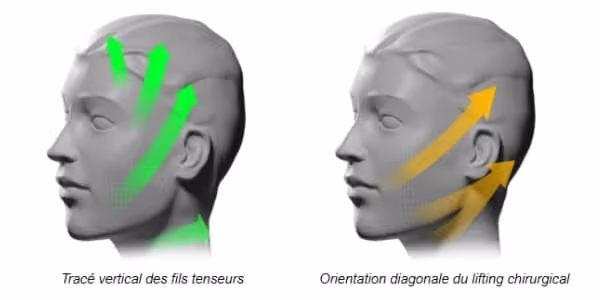 fils tenseurs