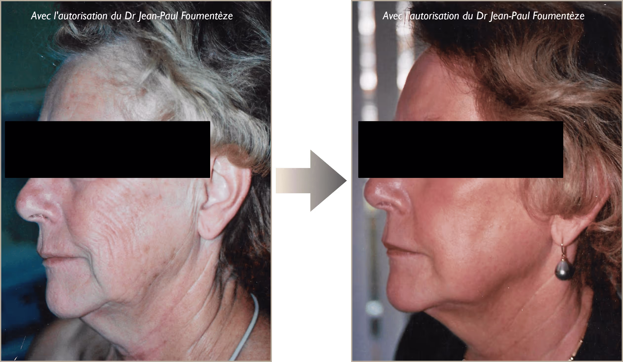 peeling phénol photo avant/après