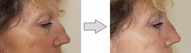 Rhinoplastie médicale