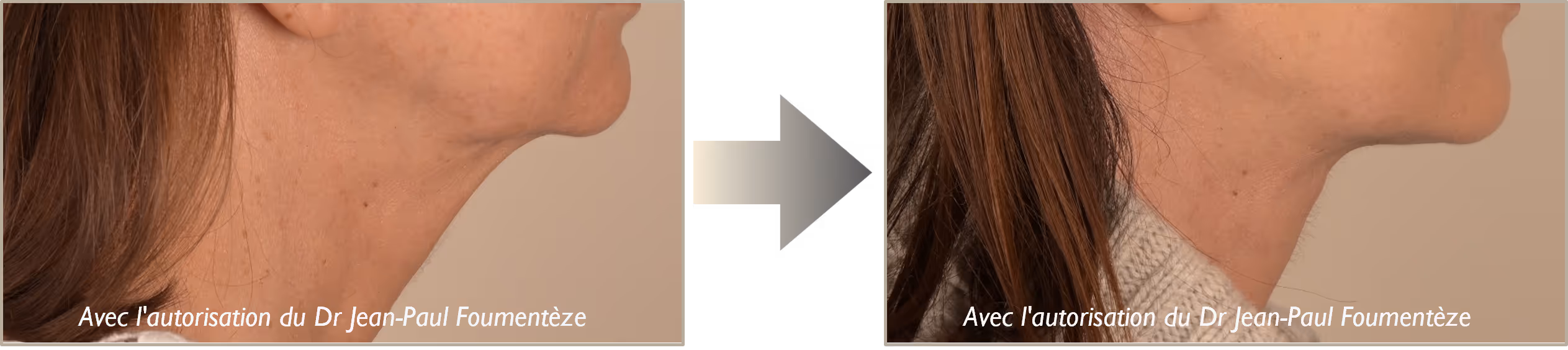 Avant-apres fils tenseurs