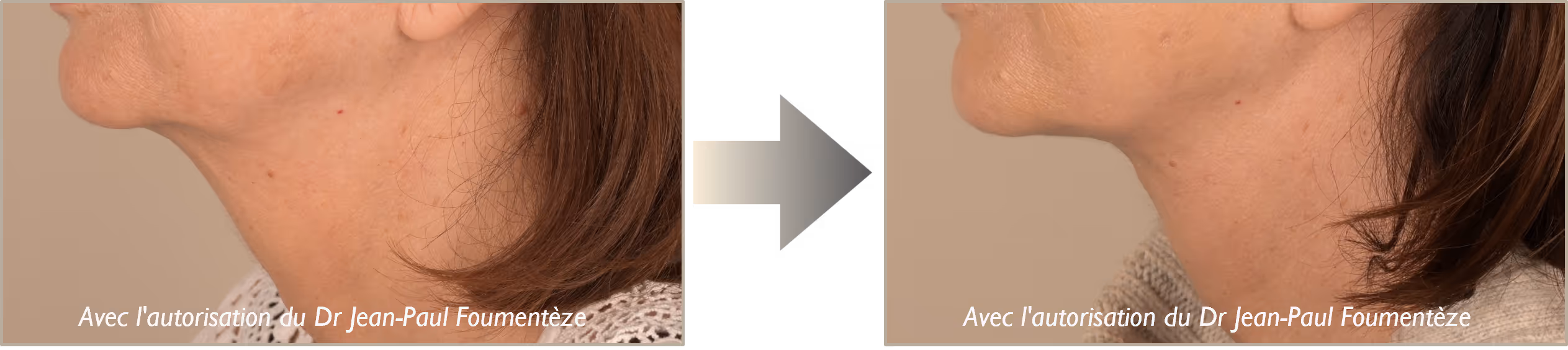 avant-apres fils tenseurs