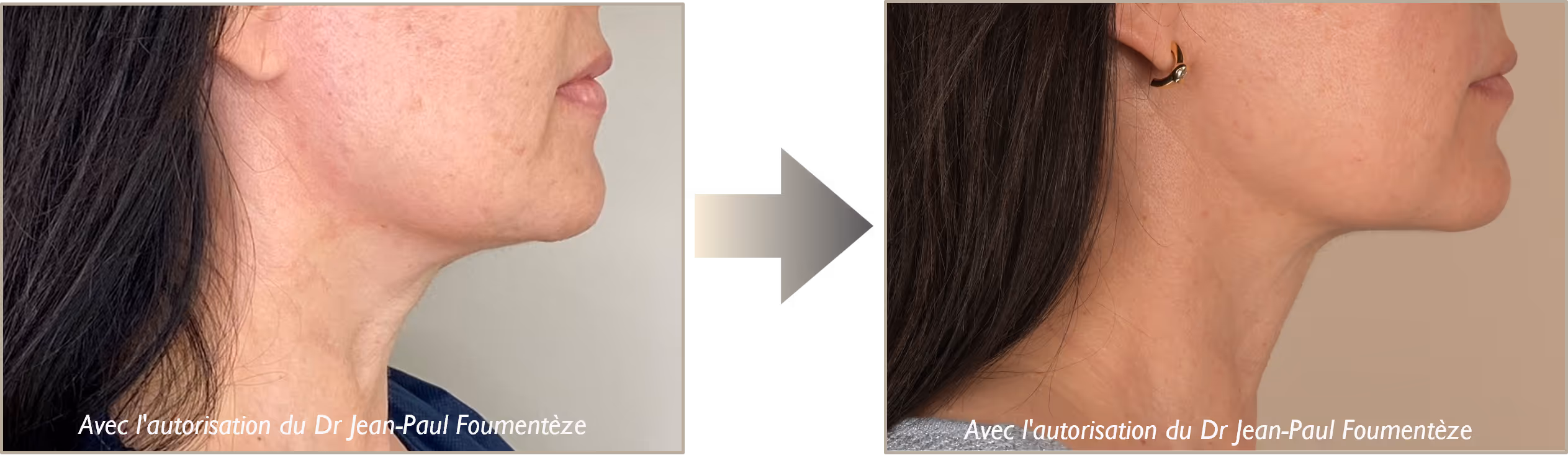 Avant-apres fils tenseurs