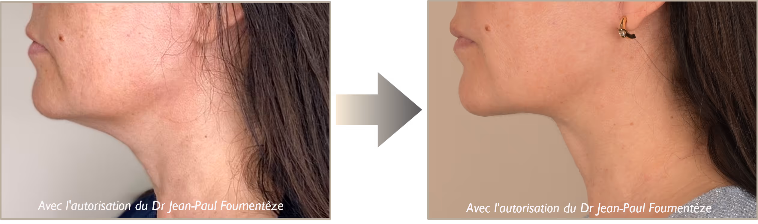 Avant-apres fils tenseurs