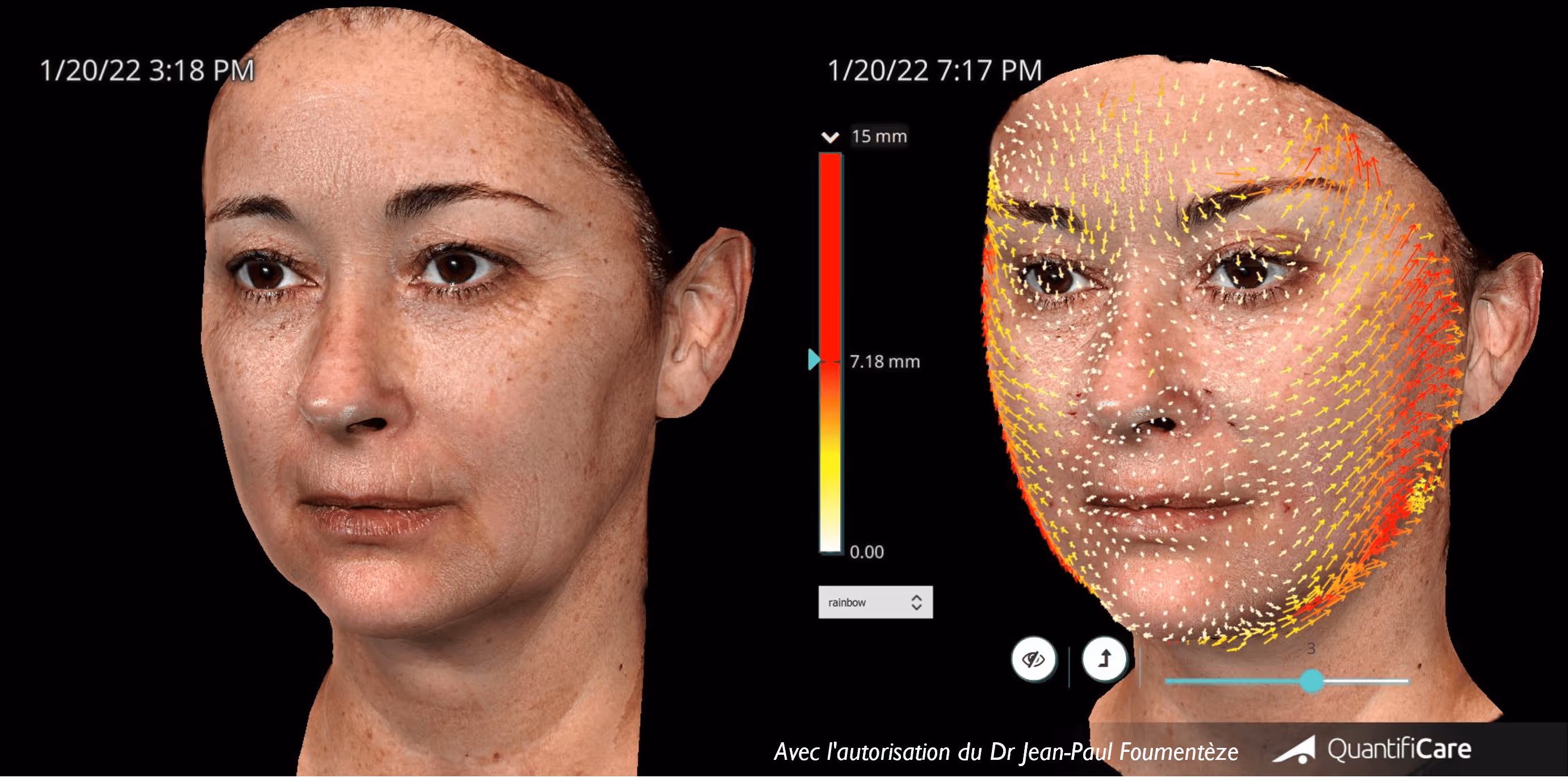 fils tenseurs regard