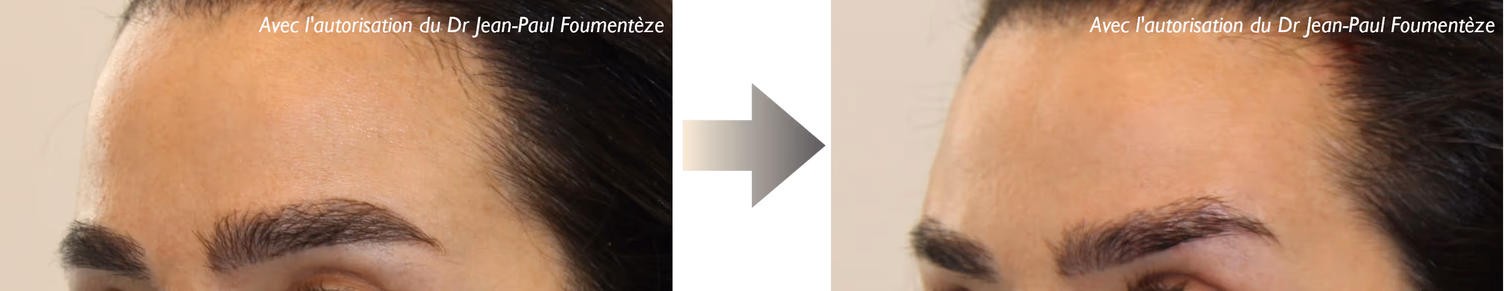 Avant et après une procédure de lift des sourcils montrant un sourcil plus relevé et lissé après traitement.