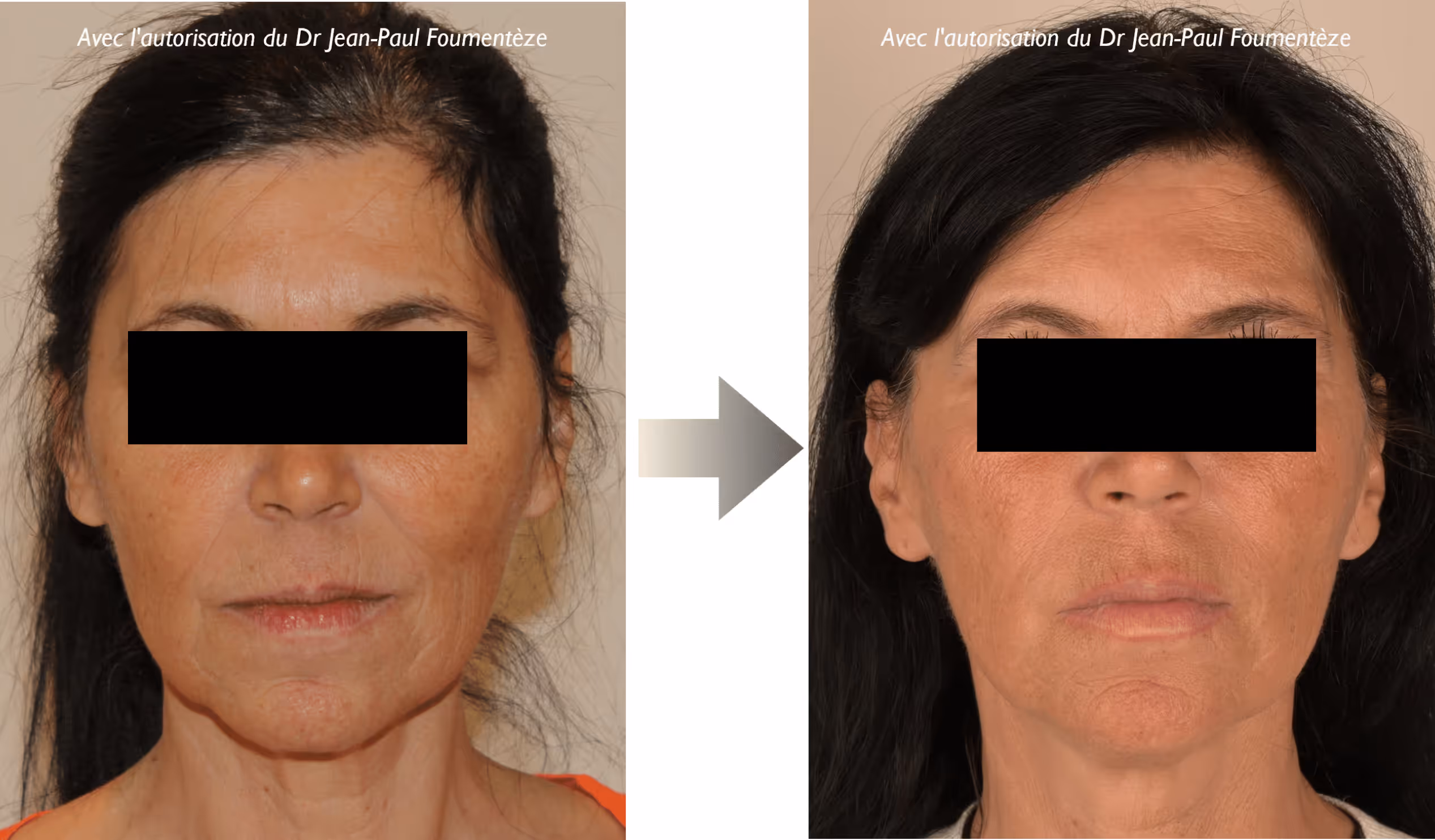 Comparaison avant et après d'une femme avec peau raffermie et lissée visible.