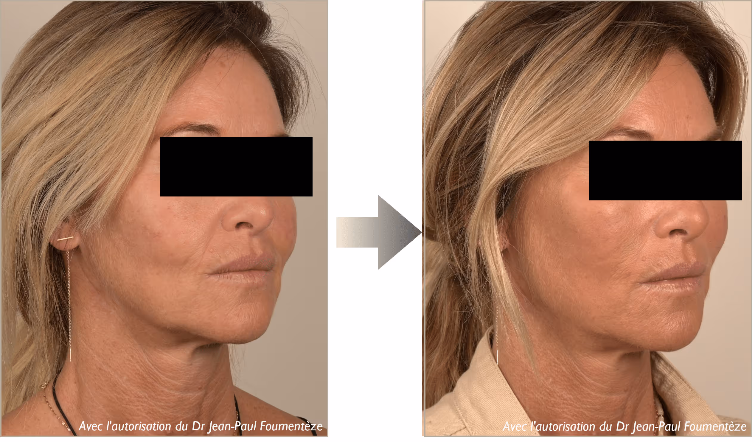 Profil avant et après d'une femme blonde avec peau plus lisse et tendue après traitement esthétique.
