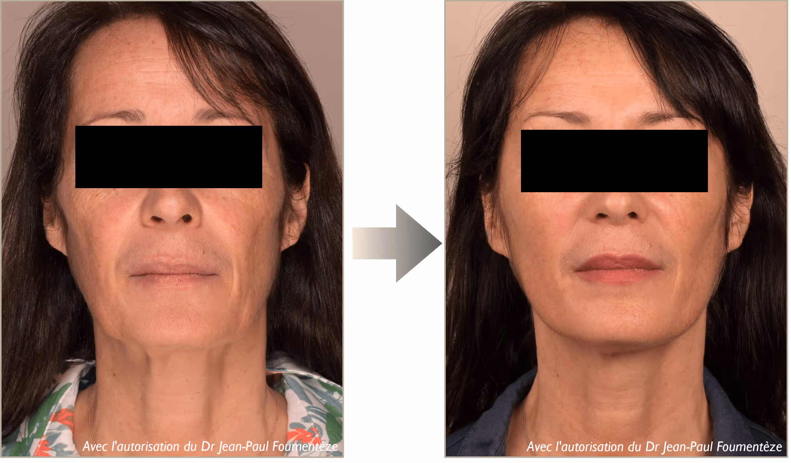 Avant et après traitement du visage d'une femme montrant une peau plus lisse et raffermie.