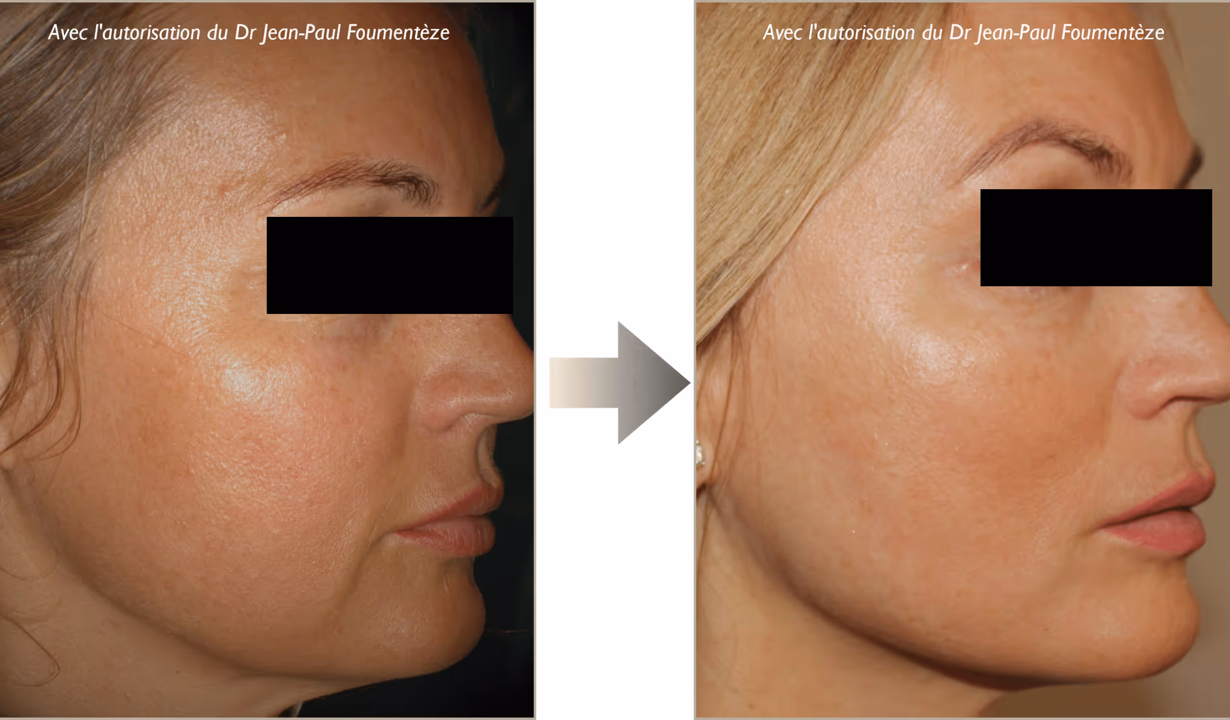 Comparaison du profil visage d'une femme avant et après un traitement de peau.
