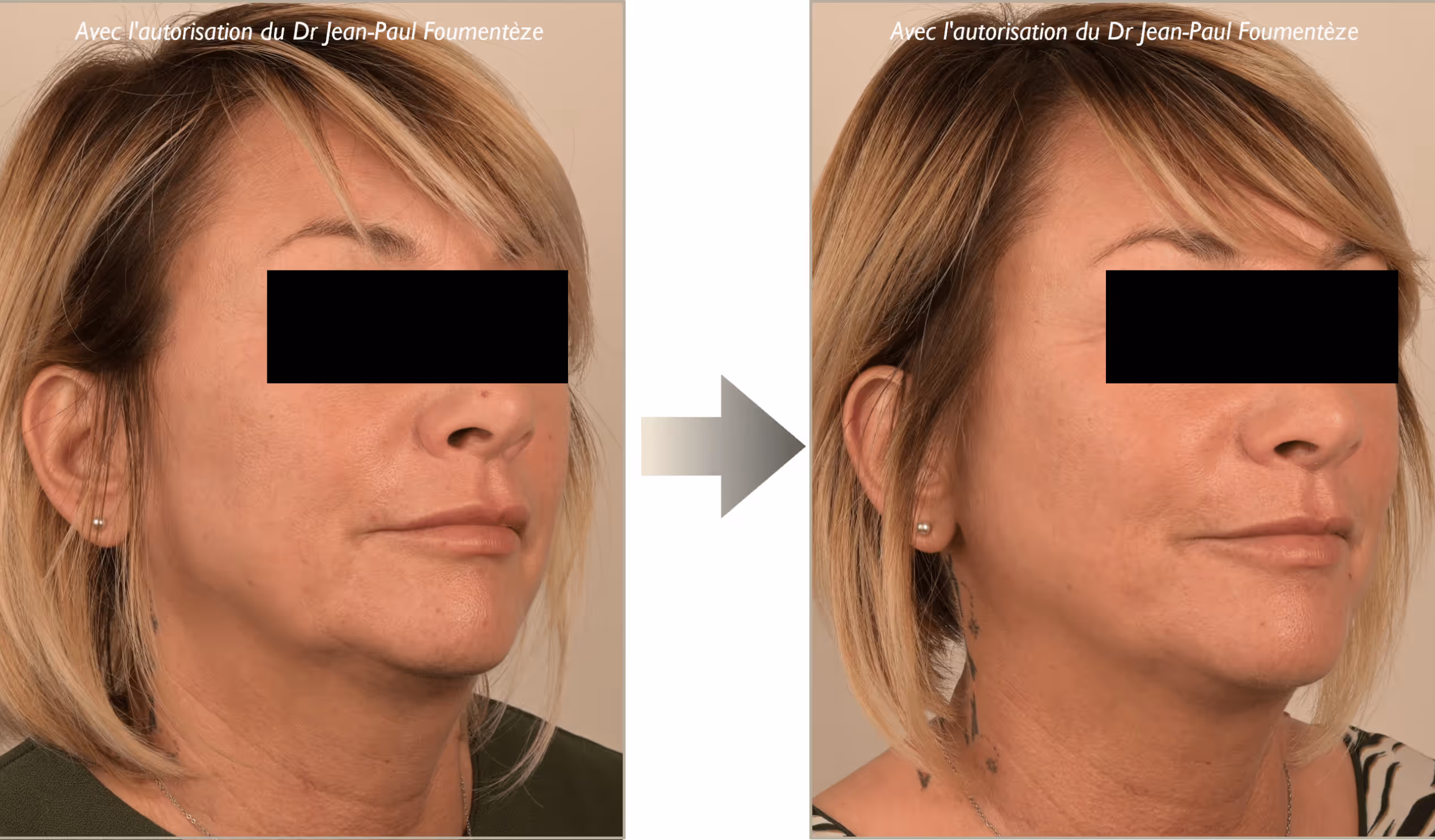 Visage féminin profil avec amélioration de la peau et réduction des rides après traitement esthétique.