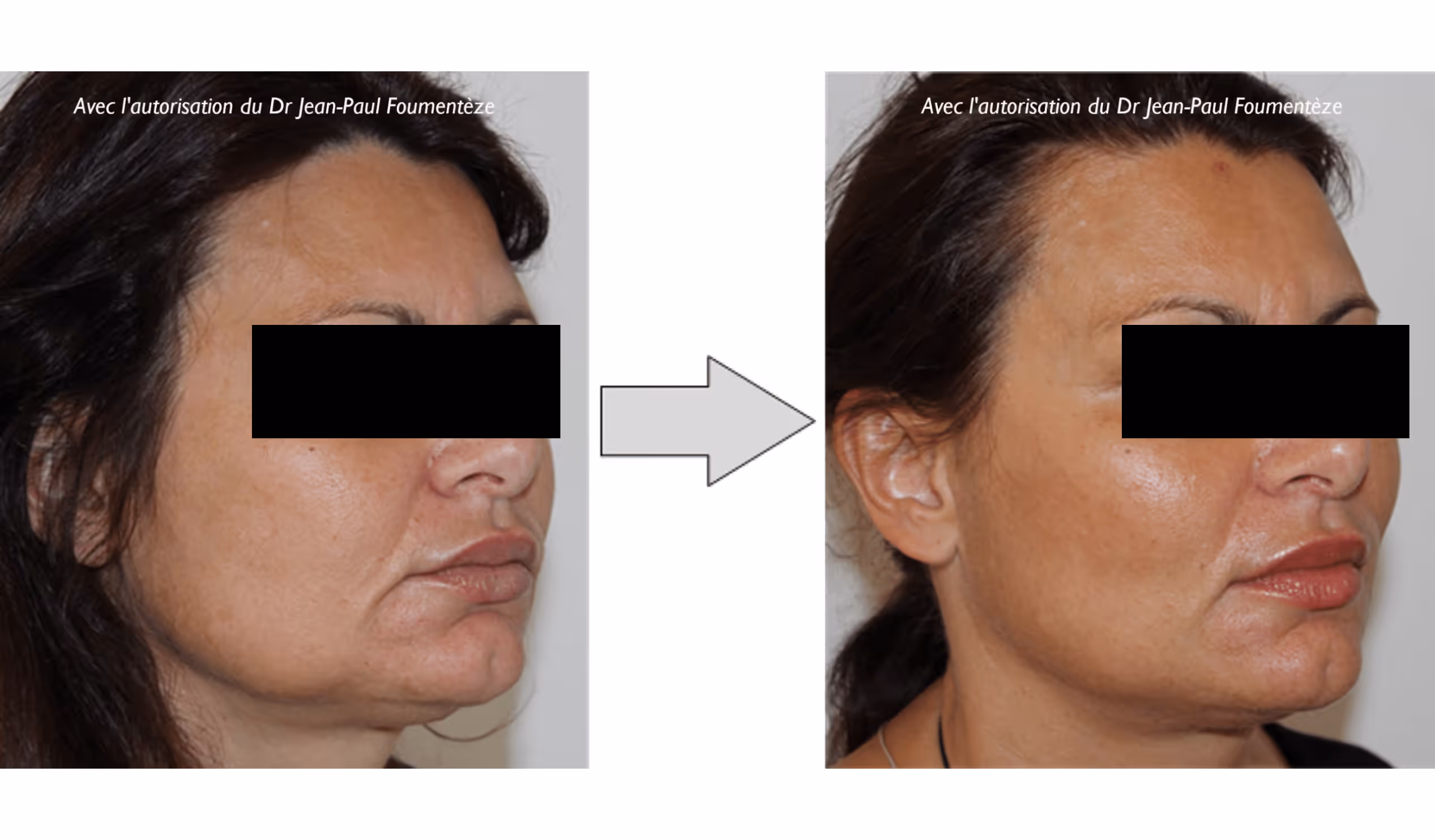 Photos avant-après montrant un lifting facial améliorant la fermeté et le contour du visage d'une femme.