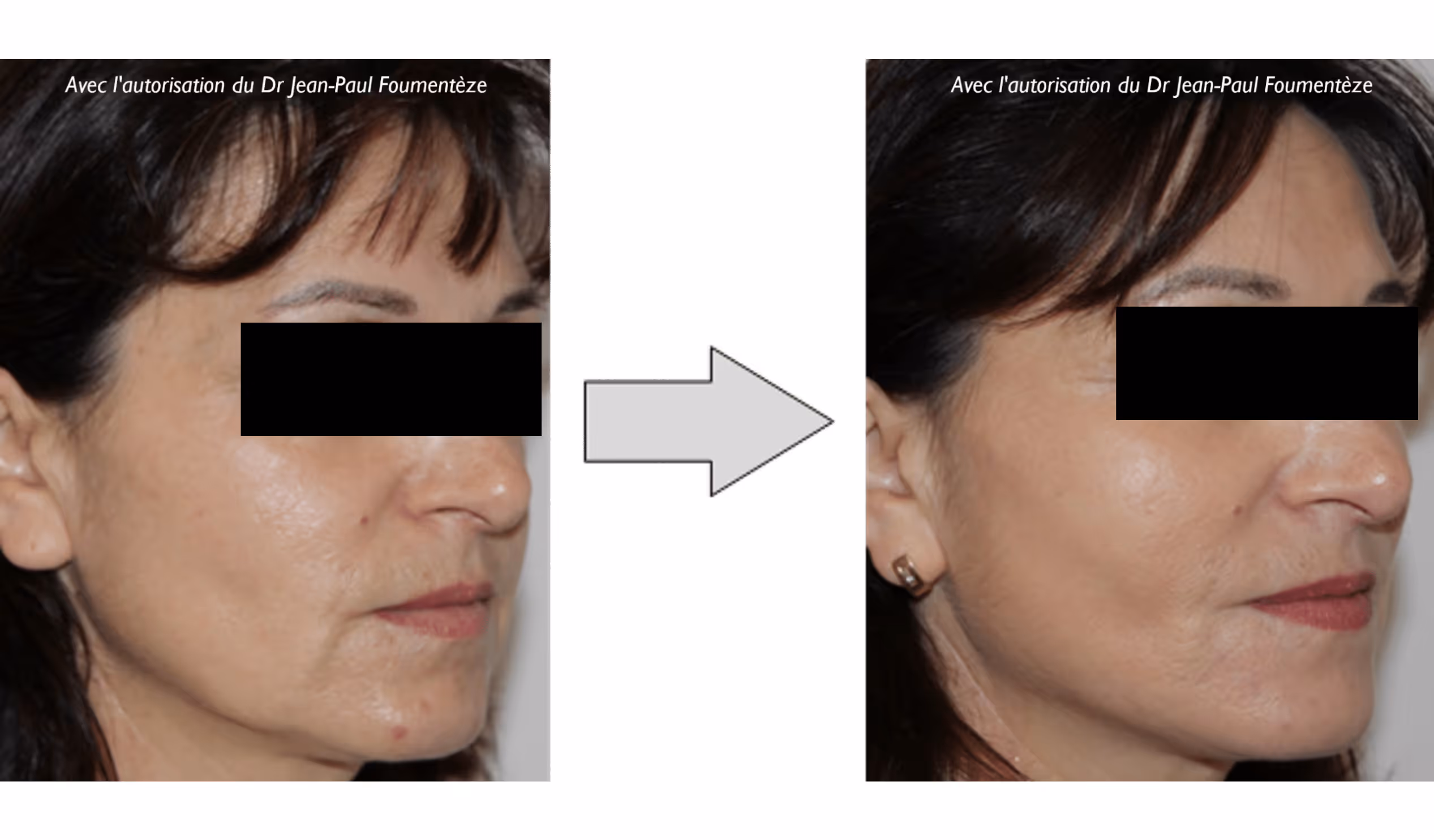 Portrait d'une femme vue de profil avant et après un traitement esthétique du visage.