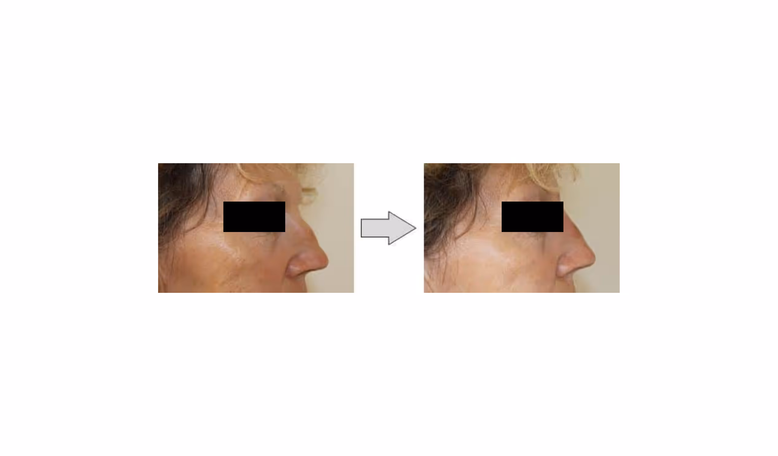 Profil de visage de femme avant et après rhinoplastie, avec les yeux masqués par un rectangle noir.
