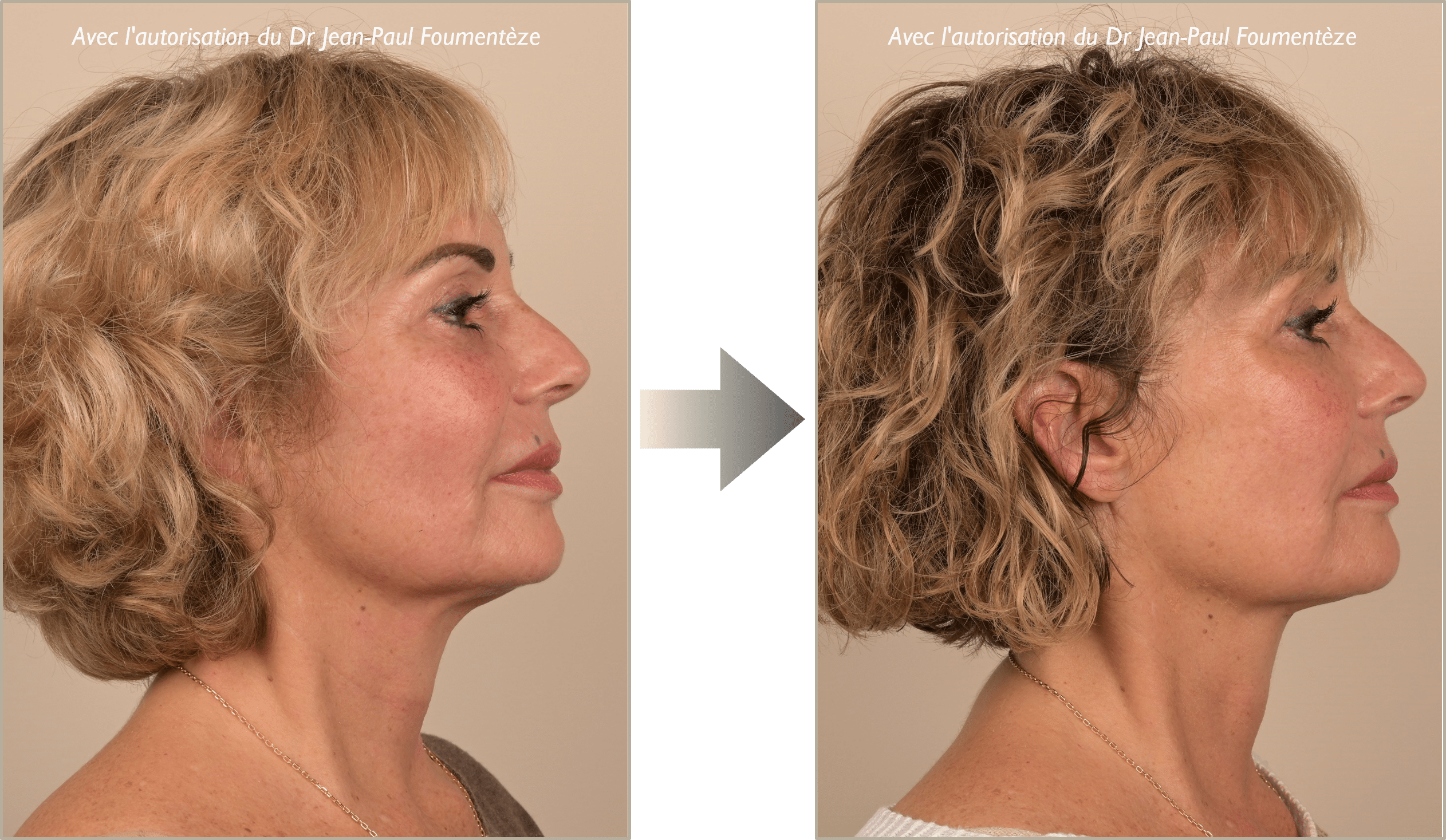 Dr. Foumenteze - Résultat de pose de fils tenseurs sur angle cervico-mentonnier & cordes platysmales – Vue de profil droit