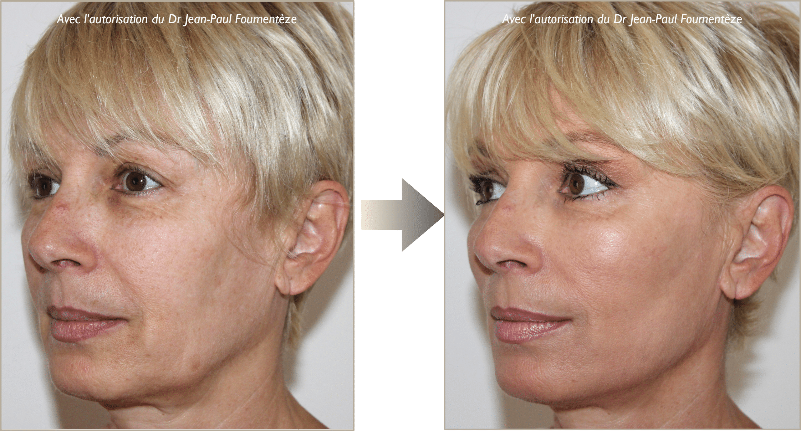 Photo avant-apres fils tenseurs permanents visage nice