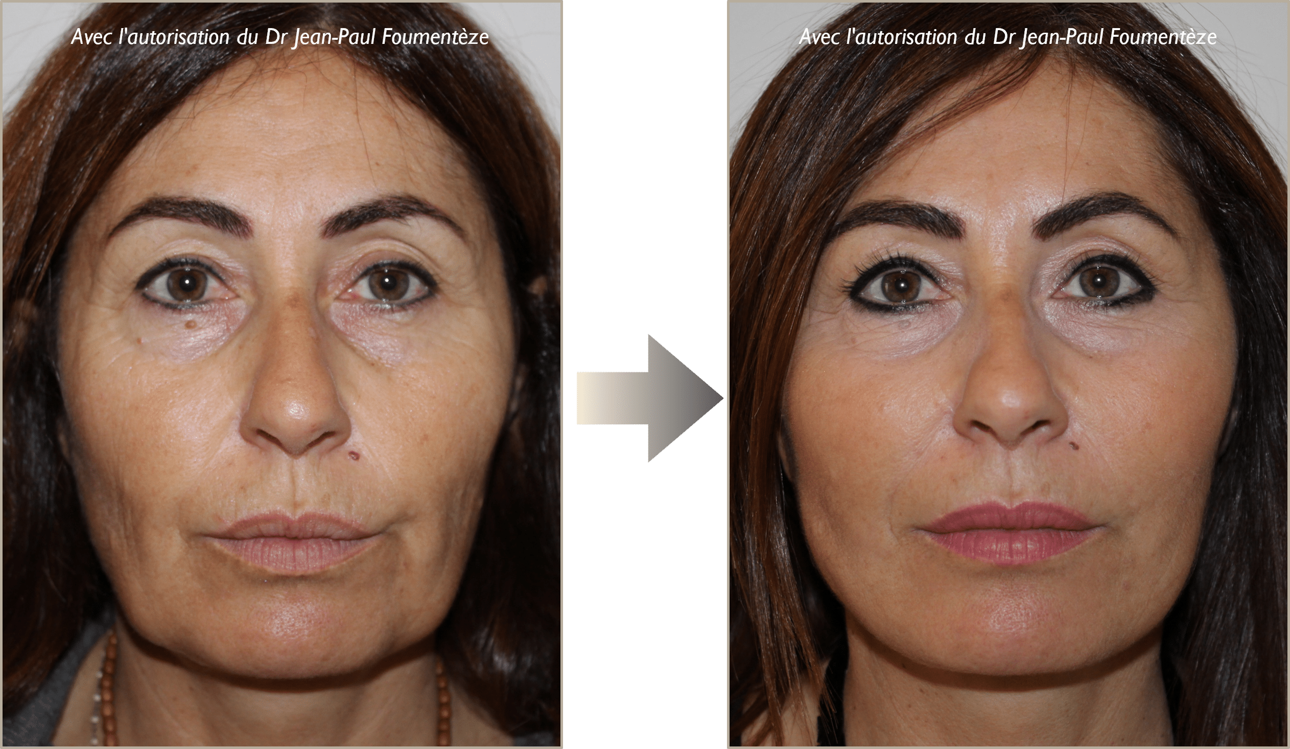 Fils Tenseurs Permanents photos avant-apres Nice