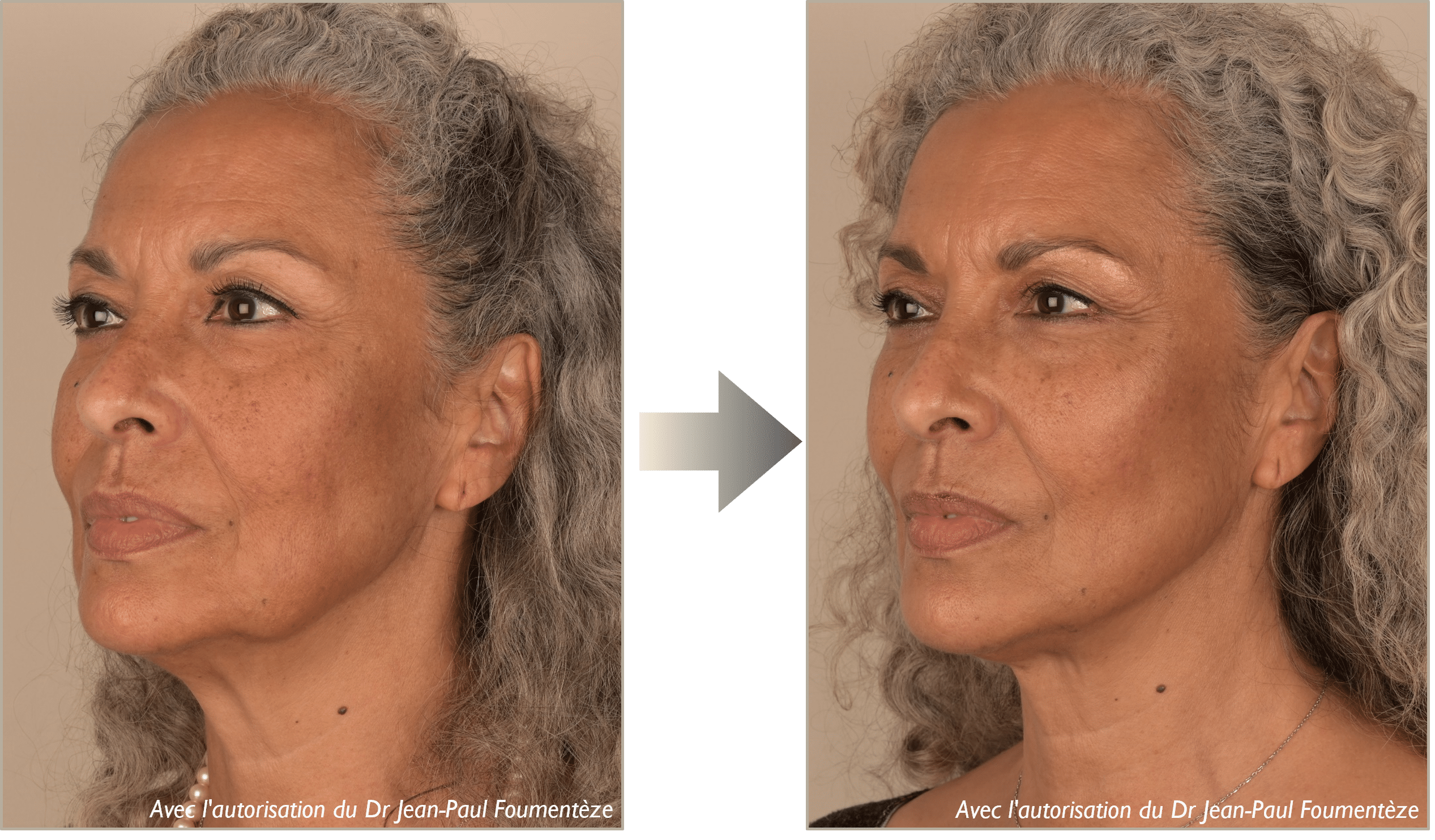 Photos fils tenseurs permanents visage