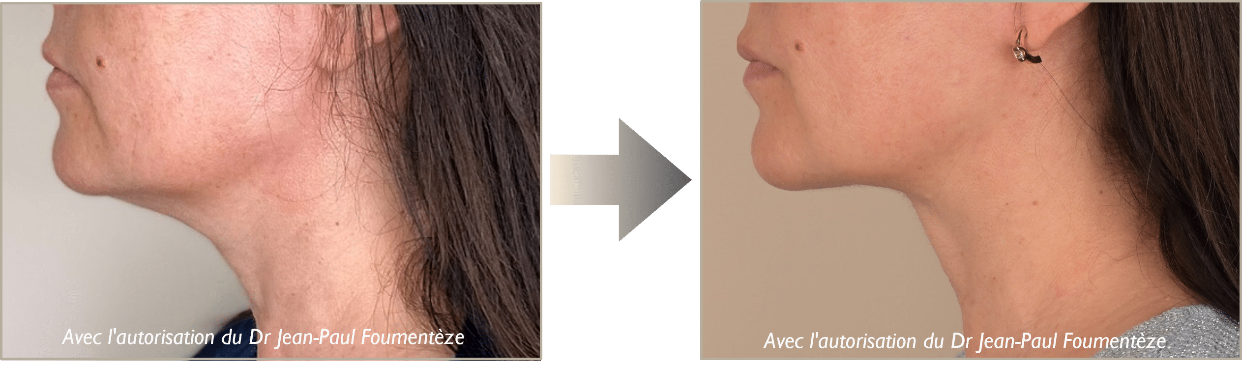 Photos fils tenseurs cou nice
