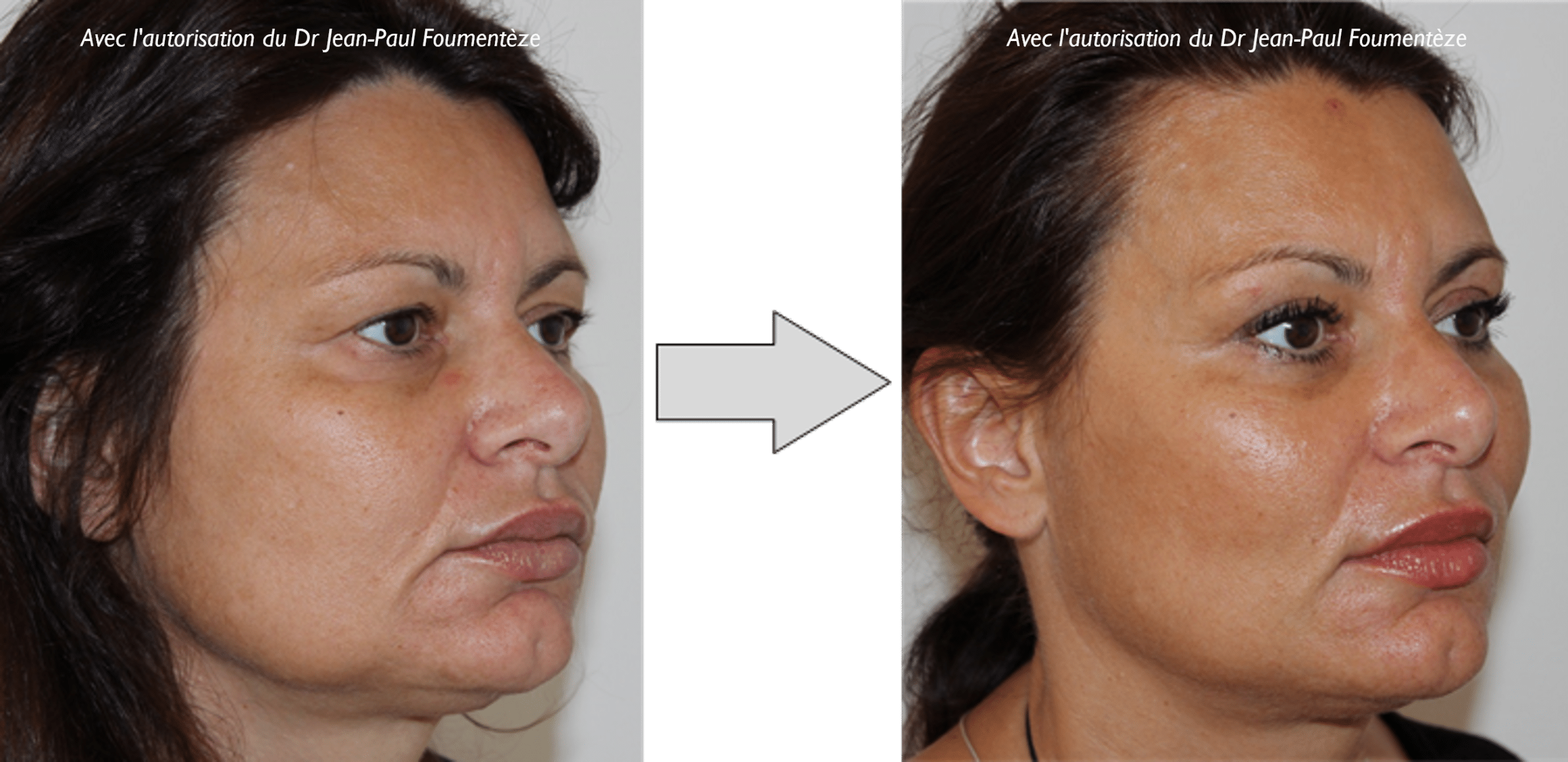Avant-apres Fils Tenseurs Permanents Visage Nice