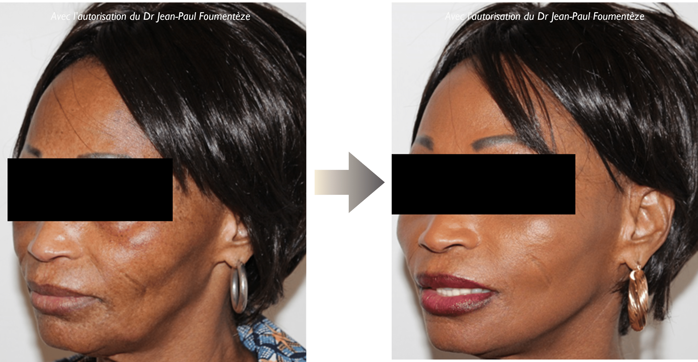 Photos Fils Tenseurs Permanents Peau Noire Nice