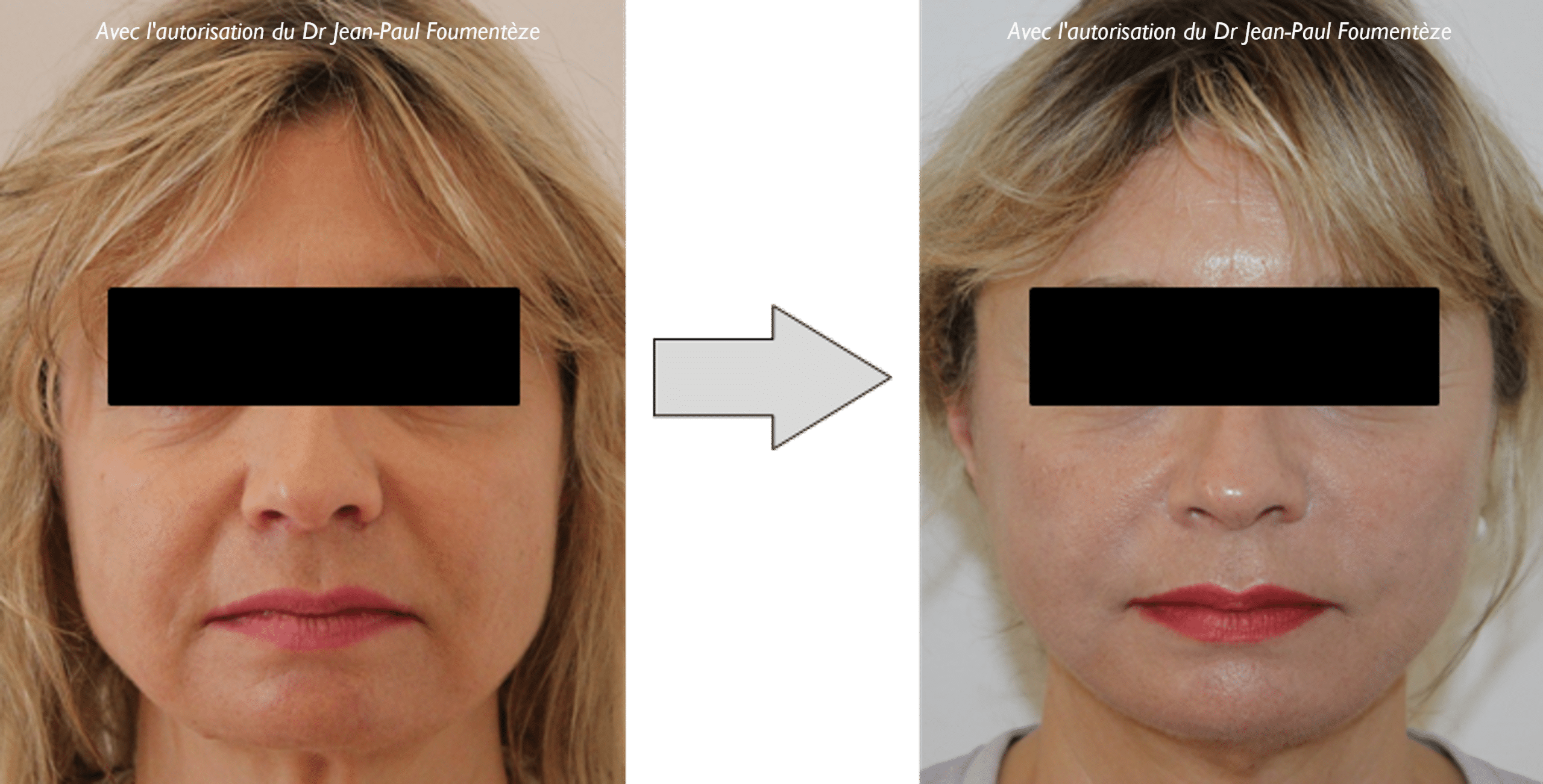 Photos fils tenseurs permanents visage
