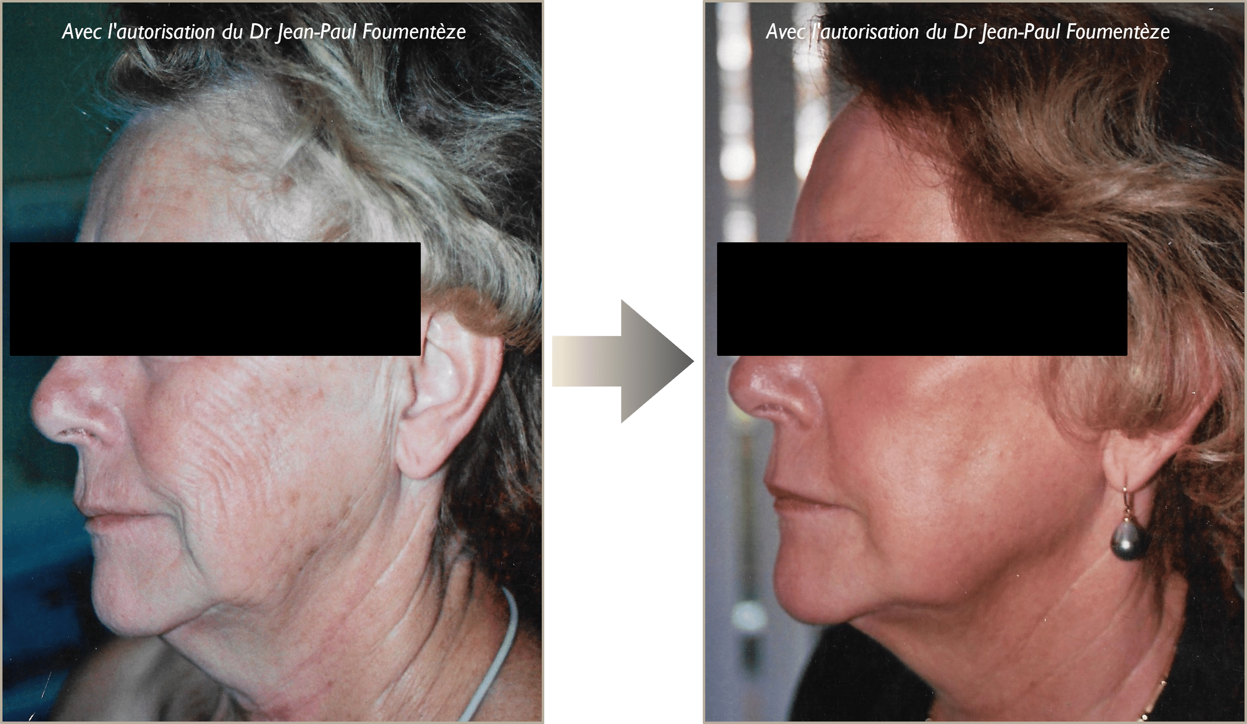 Avant-apres peeling phenol nice